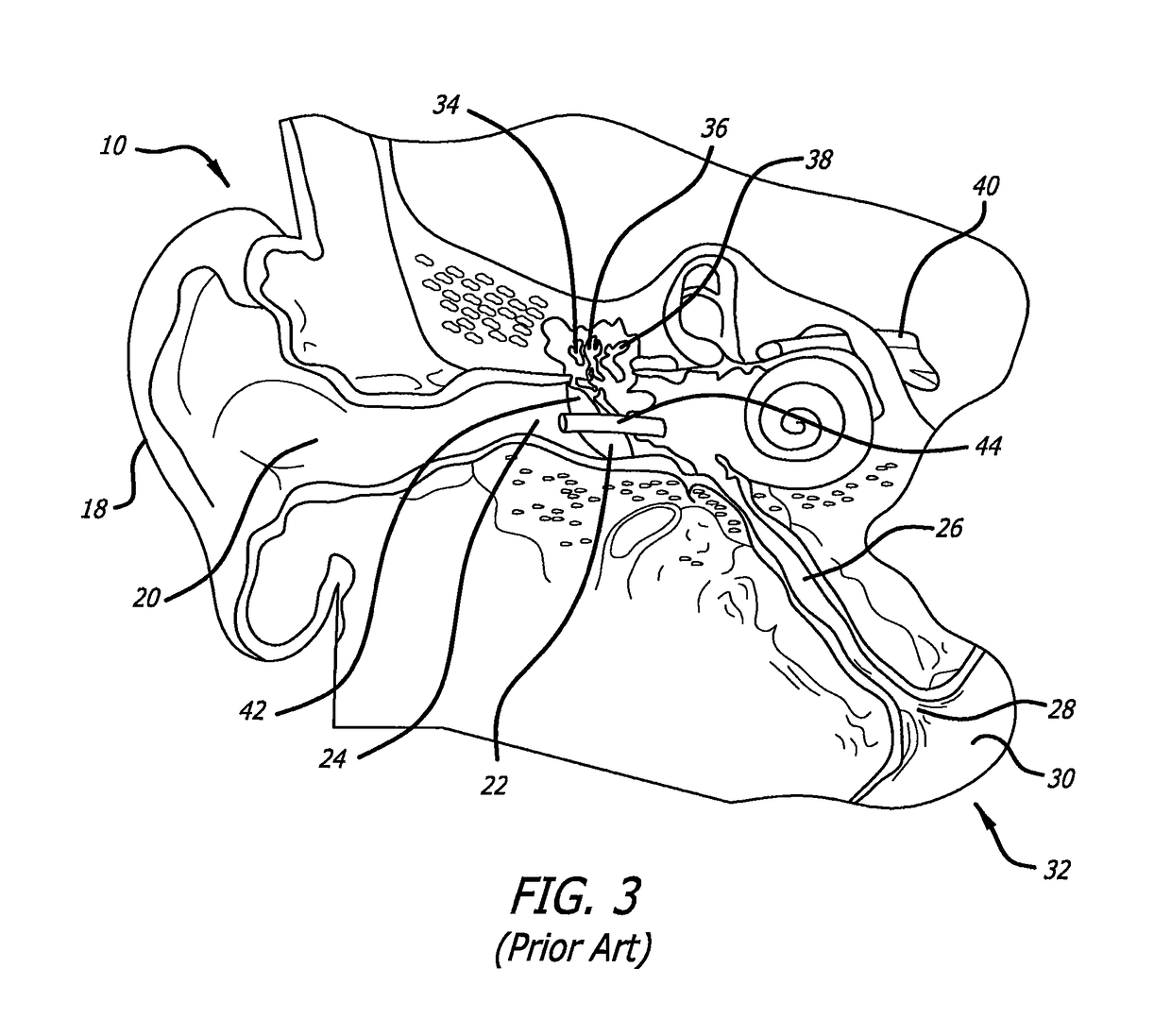 Eustachian tube dilation balloon with ventilation path