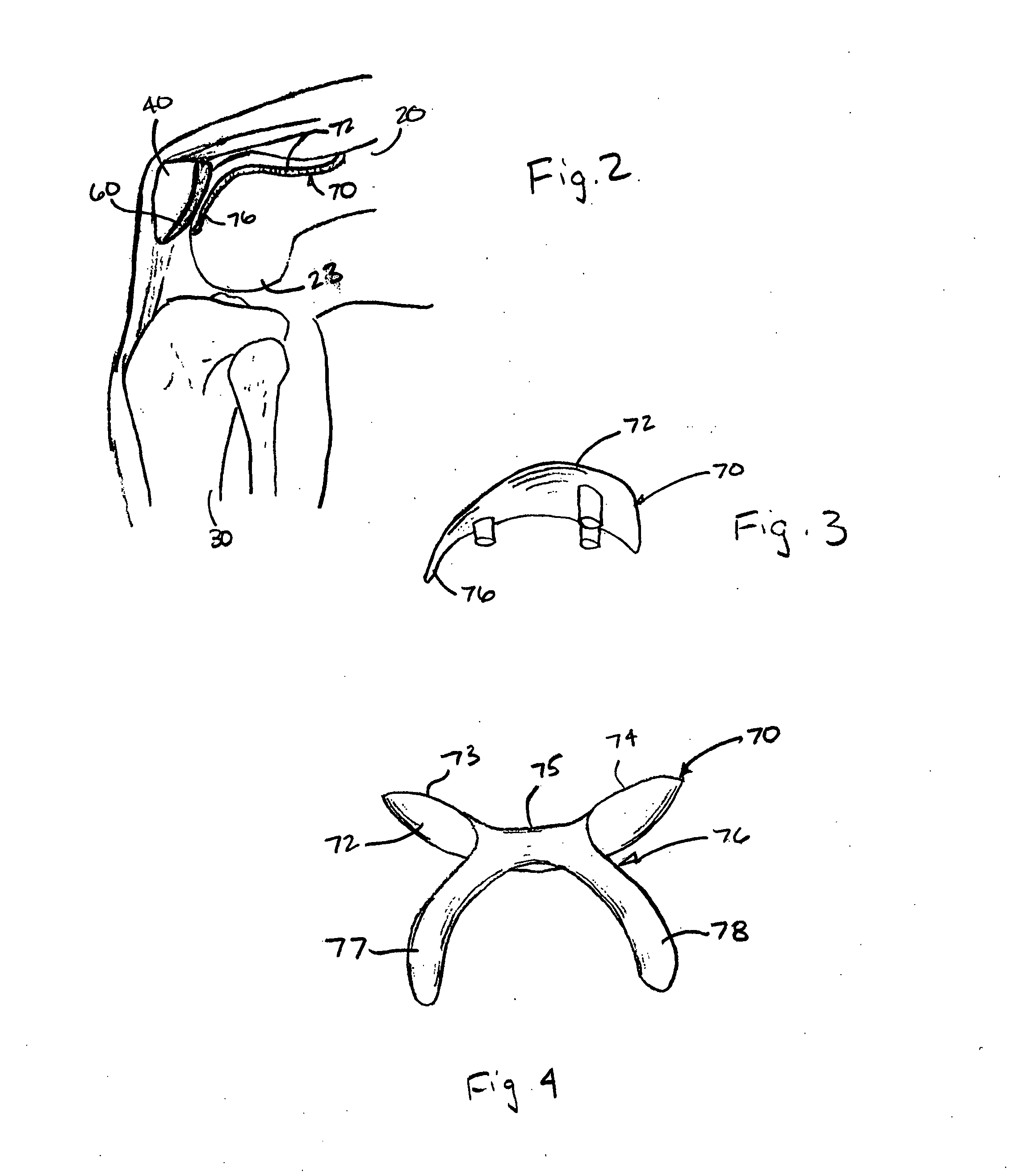 Patello-femoral prosthesis