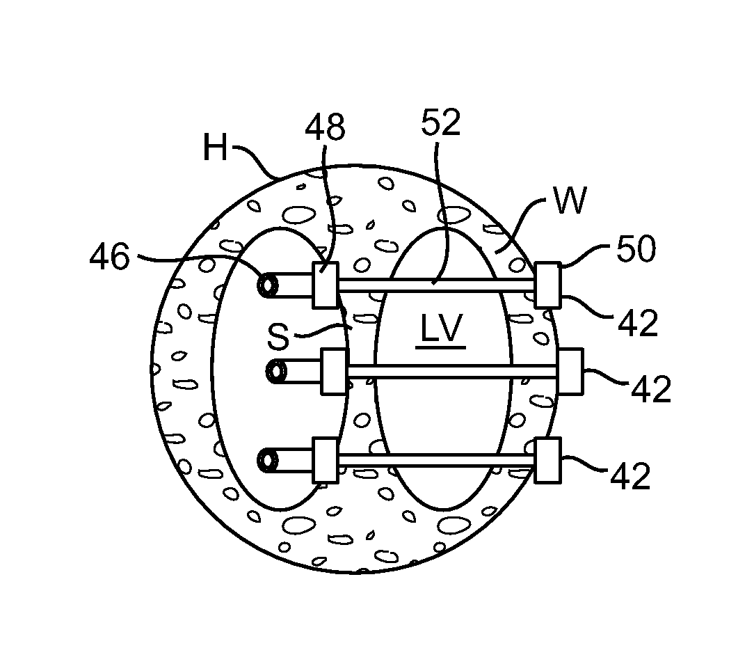 Location, time, and/or pressure determining devices, systems, and methods for deployment of lesion-excluding heart implants for treatment of cardiac heart failure and other disease states