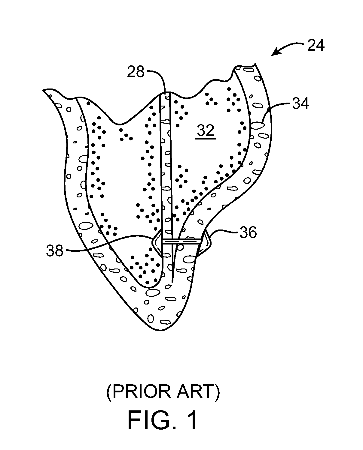 Location, time, and/or pressure determining devices, systems, and methods for deployment of lesion-excluding heart implants for treatment of cardiac heart failure and other disease states