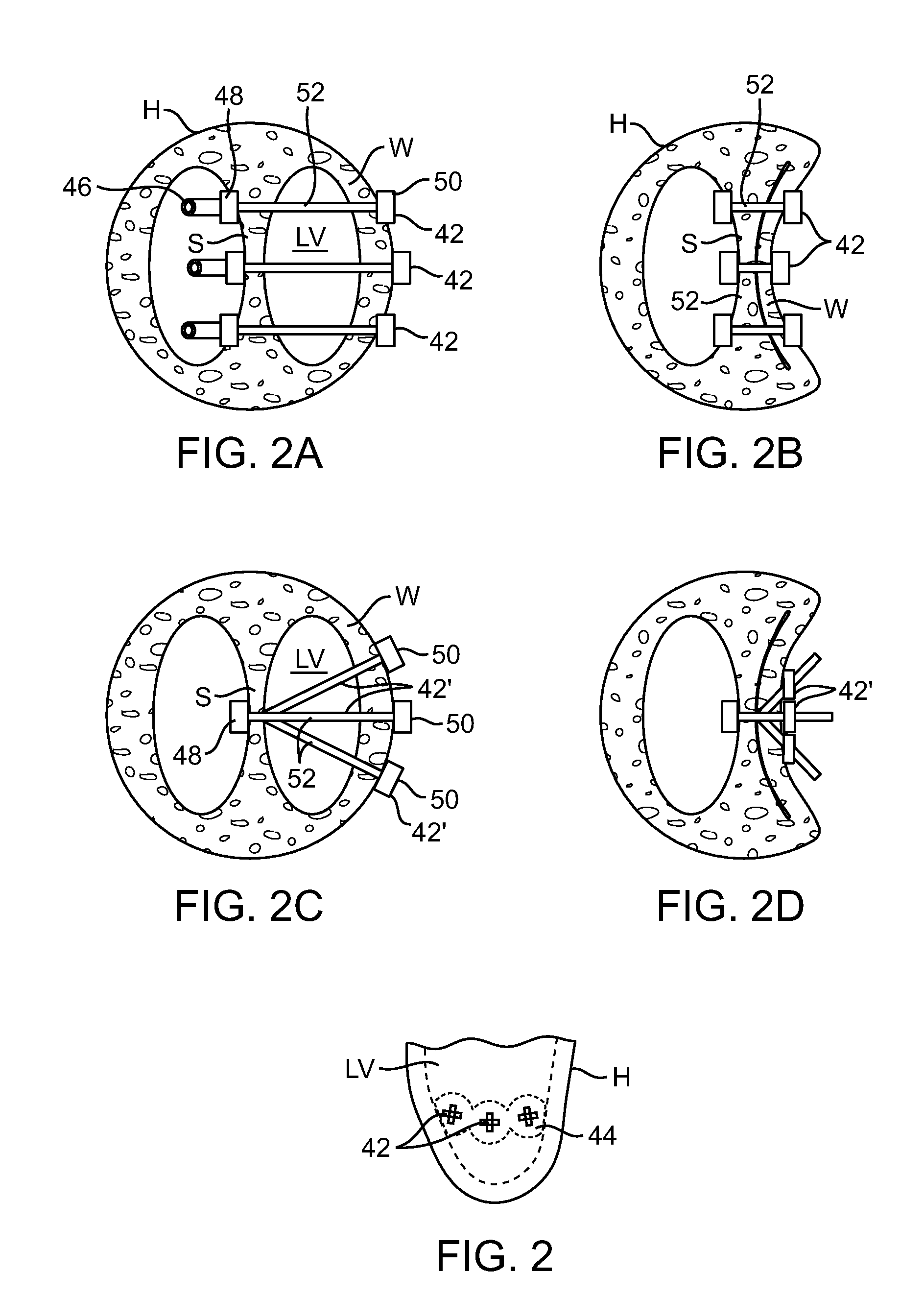 Location, time, and/or pressure determining devices, systems, and methods for deployment of lesion-excluding heart implants for treatment of cardiac heart failure and other disease states