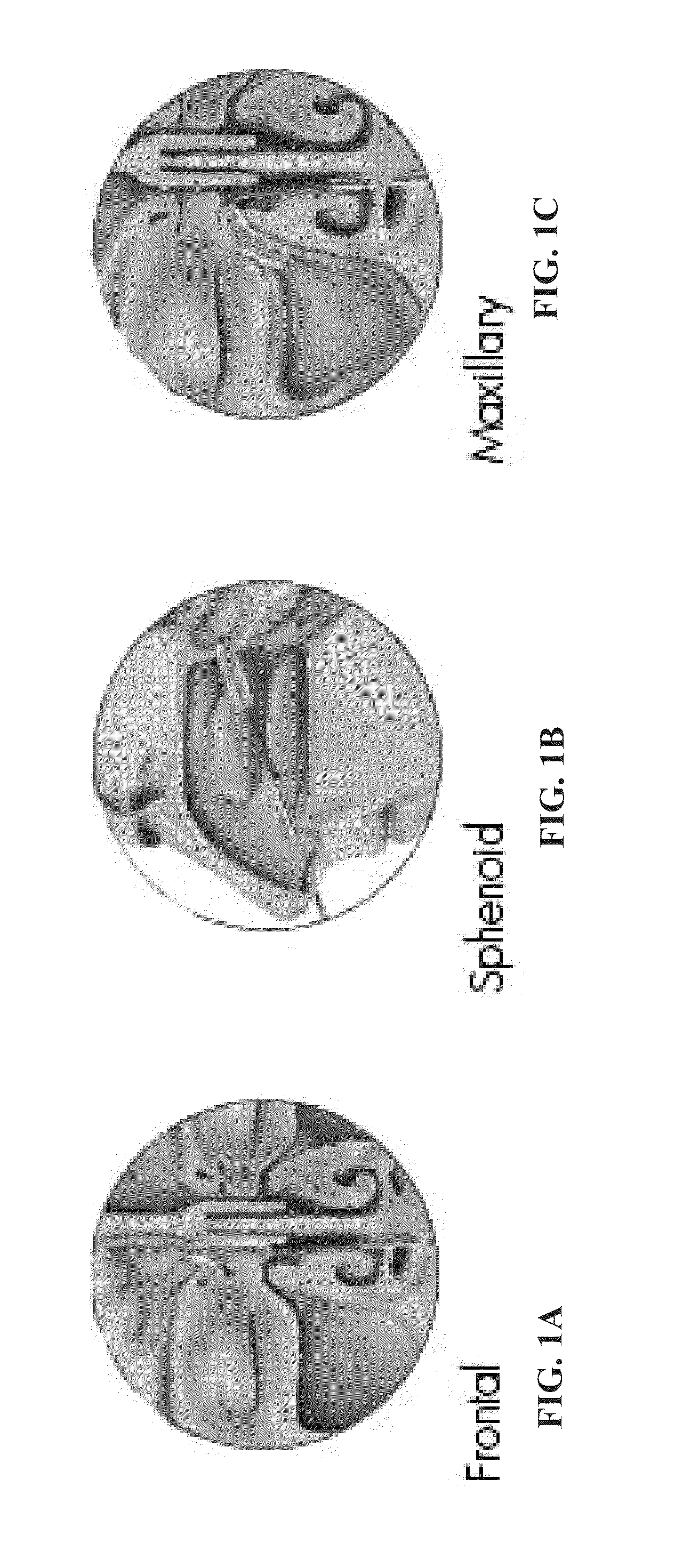 Transplantation of cells into the nasal cavity and the subarachnoid cranial space