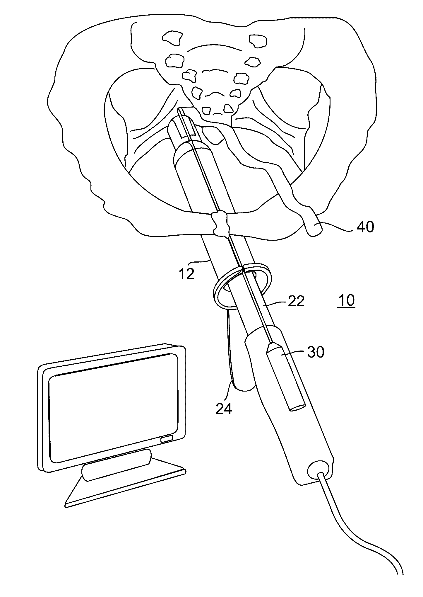 System and method for pelvic floor repair