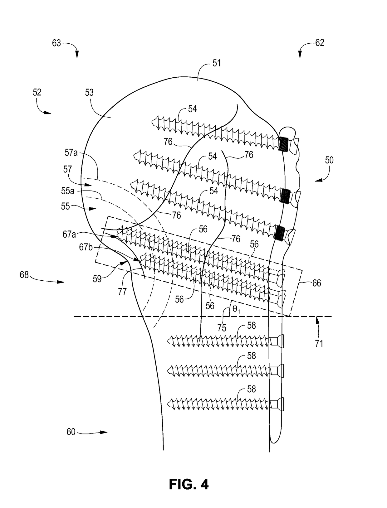 Fixation device for proximal humerus fractures