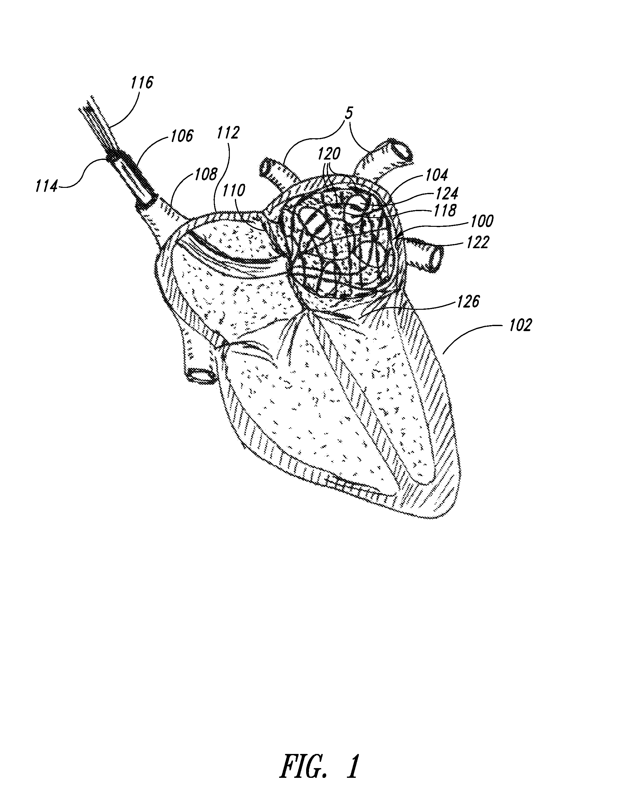 Medical device for use in bodily lumens, for example an atrium