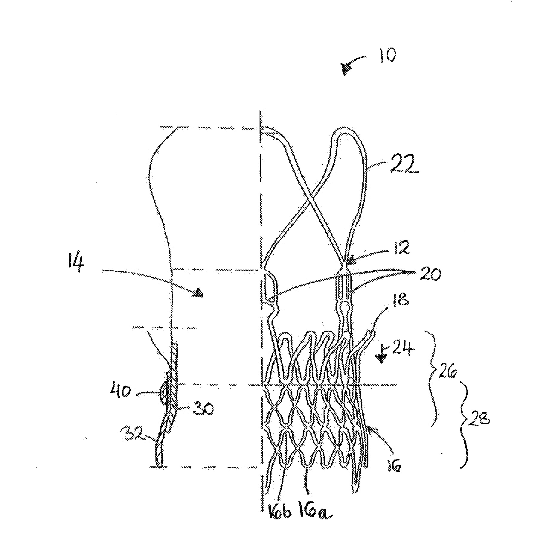 Prosthesis Seals and Methods for Sealing an Expandable Prosthesis