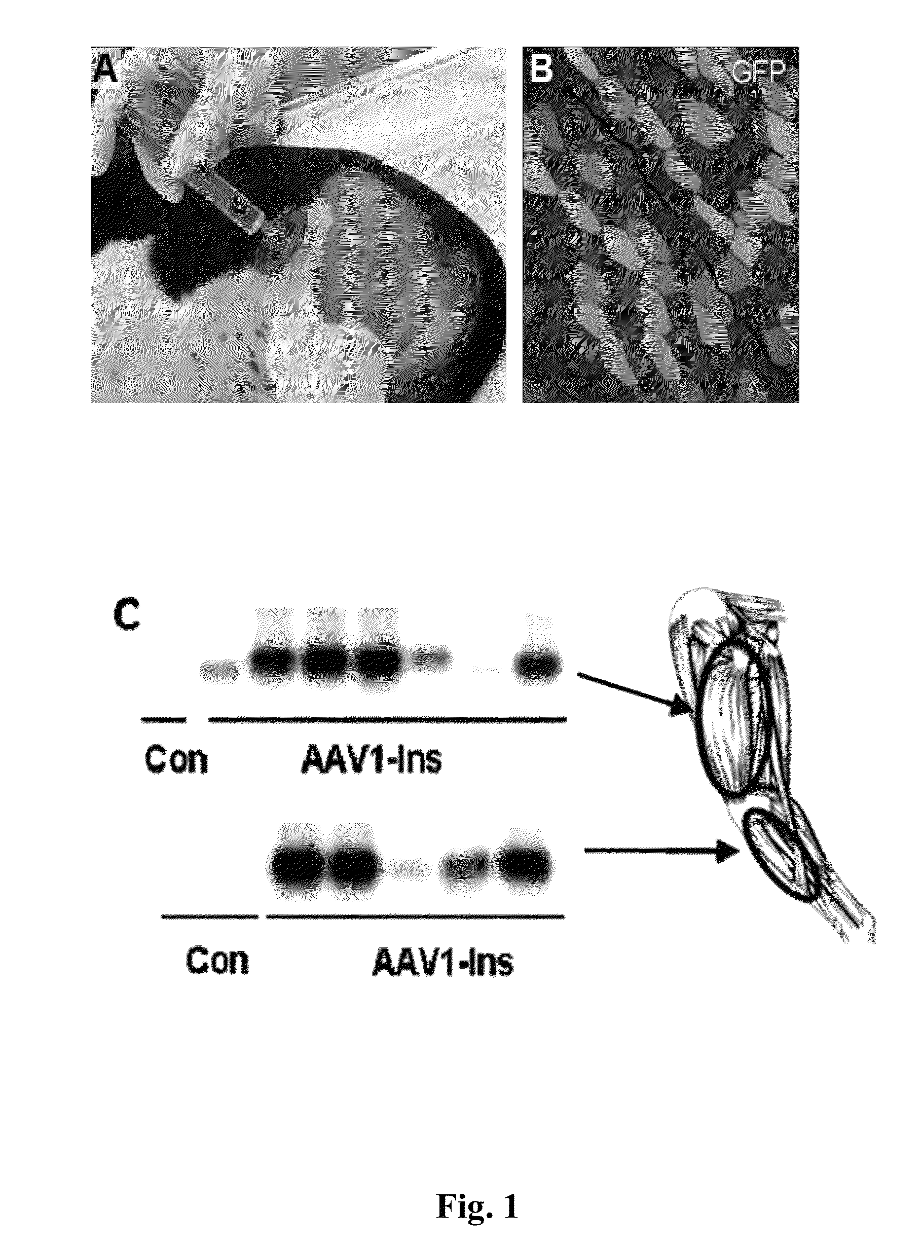 Gene therapy composition for use in diabetes treatment