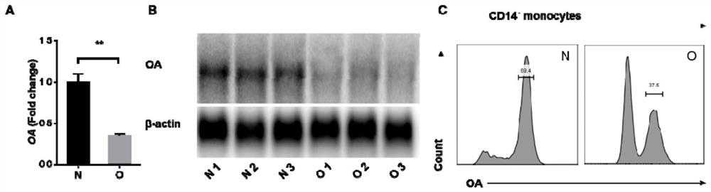 Biomarker OA (osteoactivin) for detecting postmenopausal osteoporosis and kit of biomarker OA