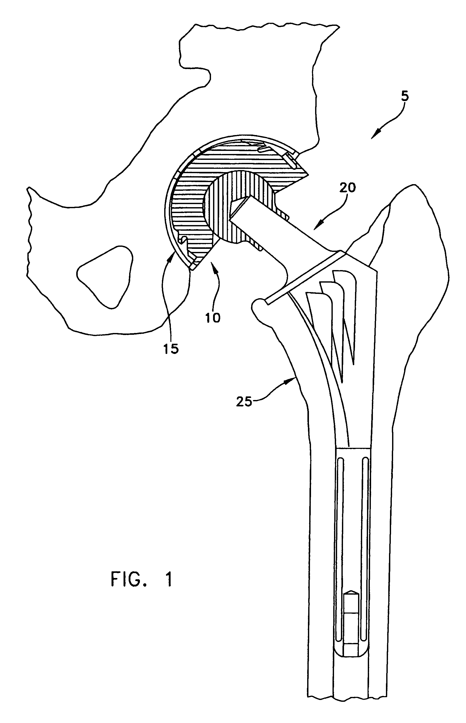 Bimetal acetabular component construct for hip joint prosthesis