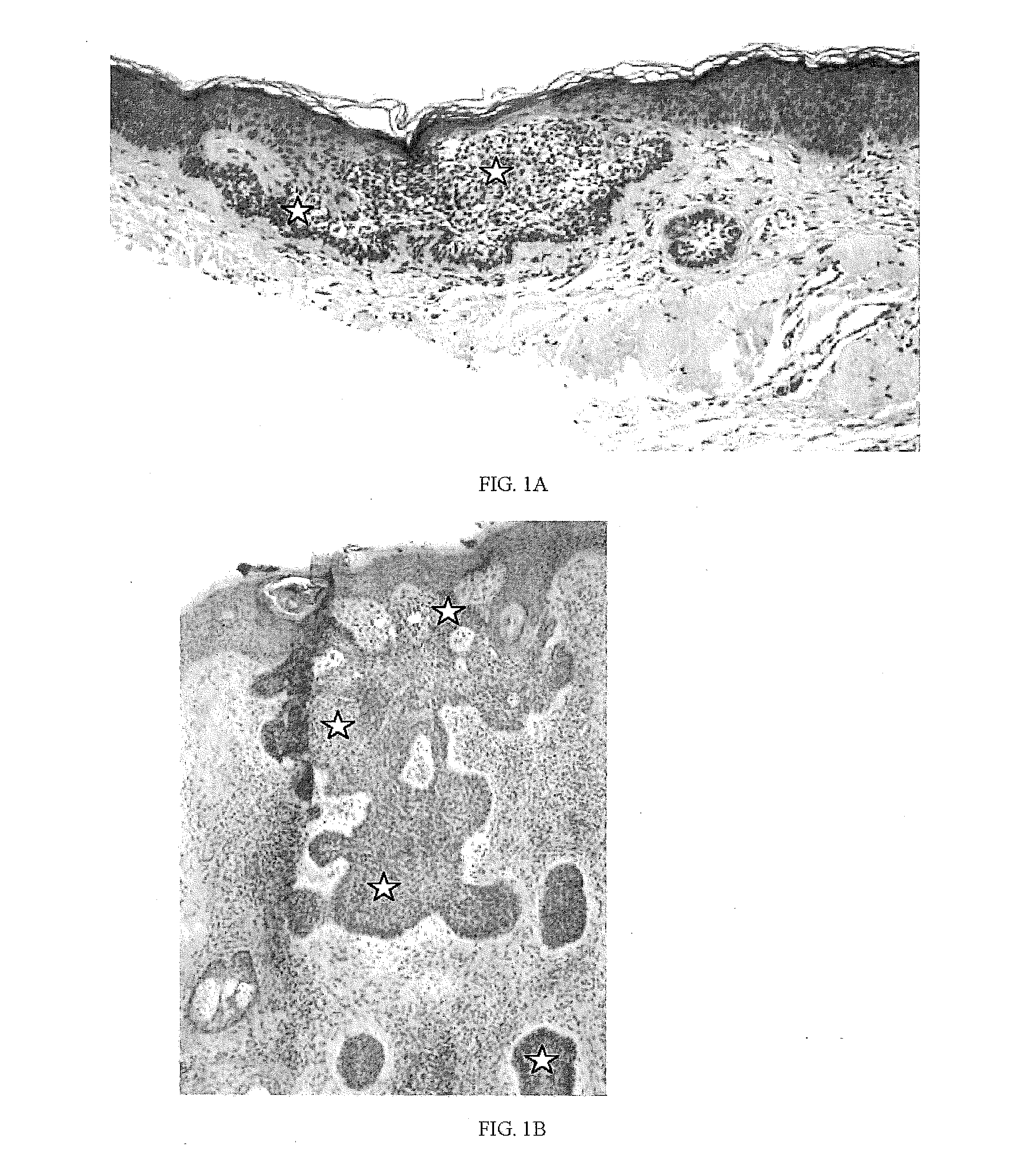 Method and Apparatus for Skin Cancer Thermal Therapy