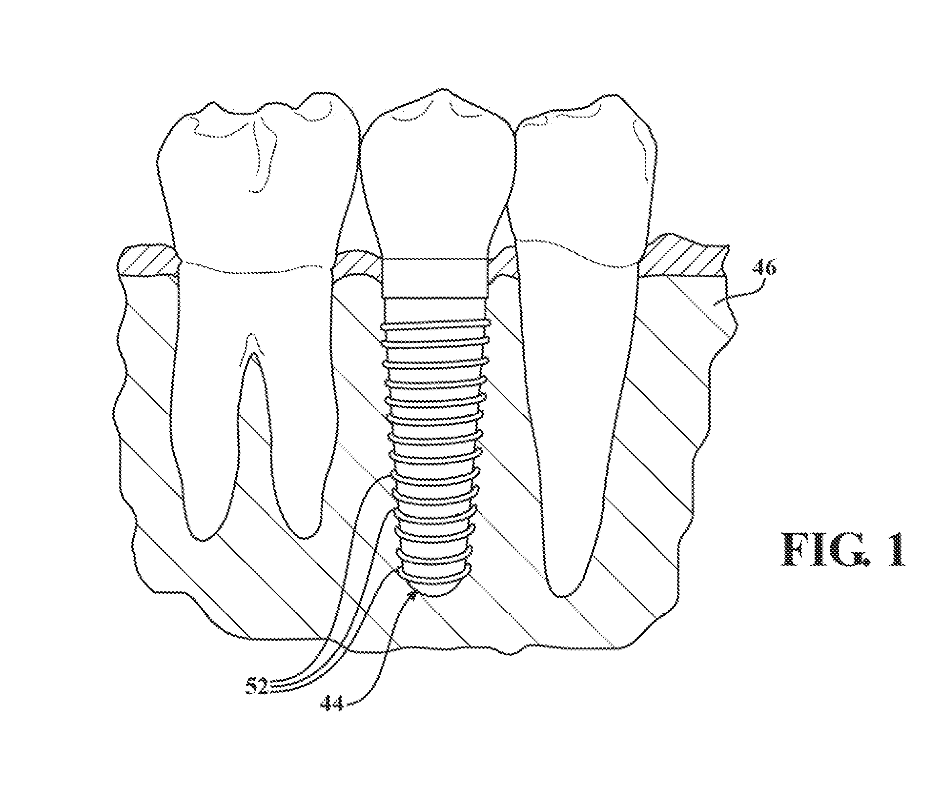 Fluted osteotome and surgical method for use