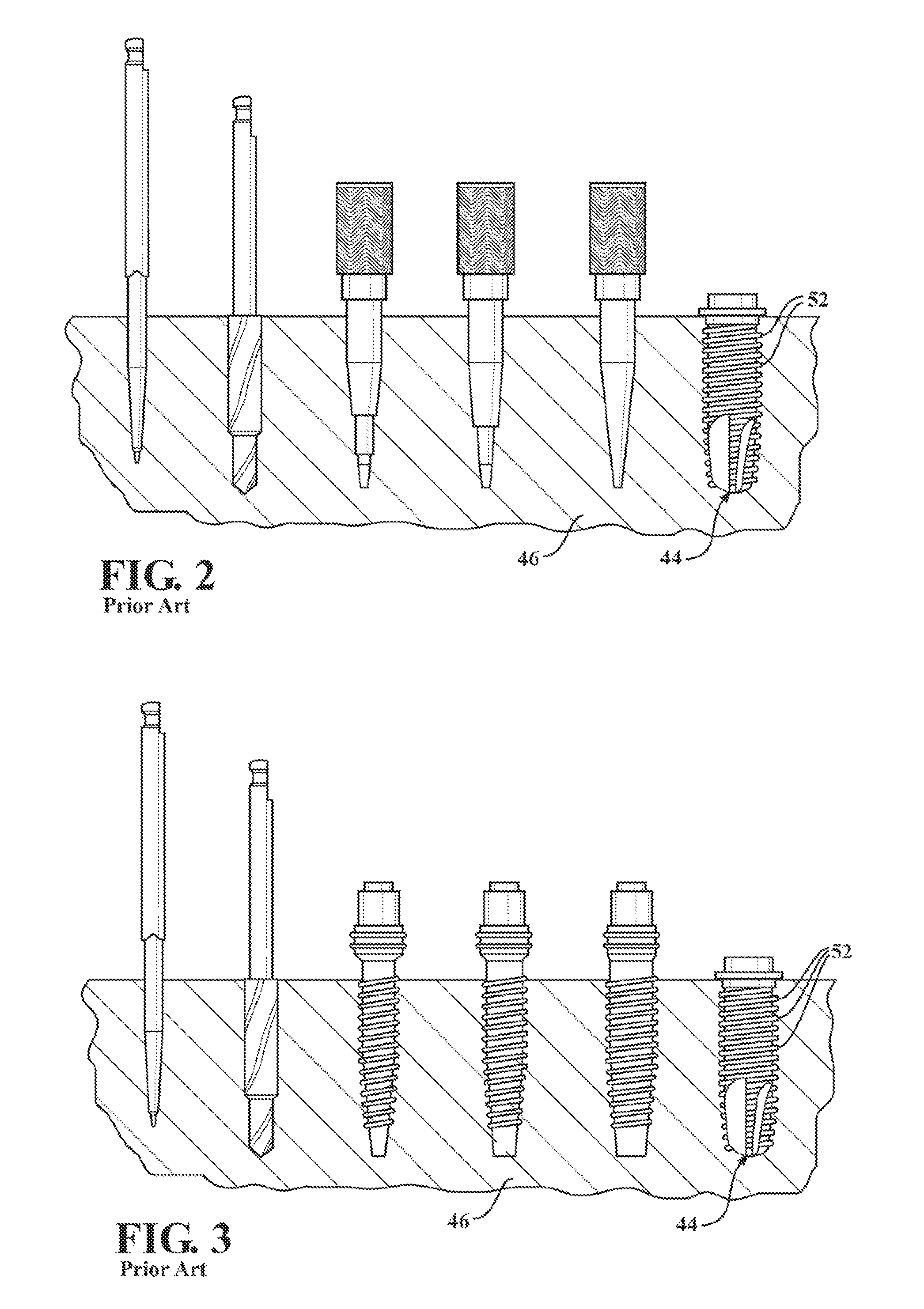 Fluted osteotome and surgical method for use