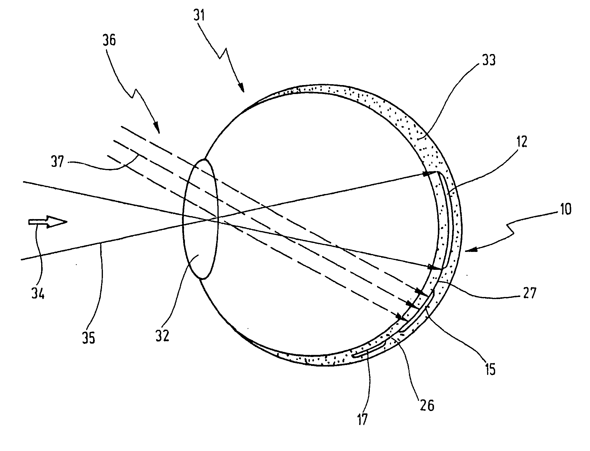 Active retina implant with a multiplicity of pixel elements