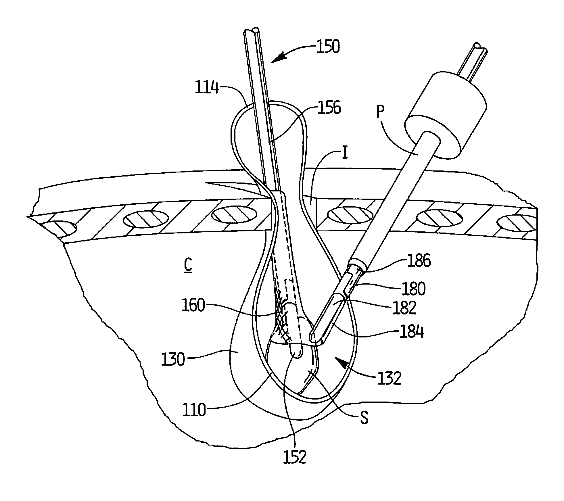 Surgical retrieval apparatus