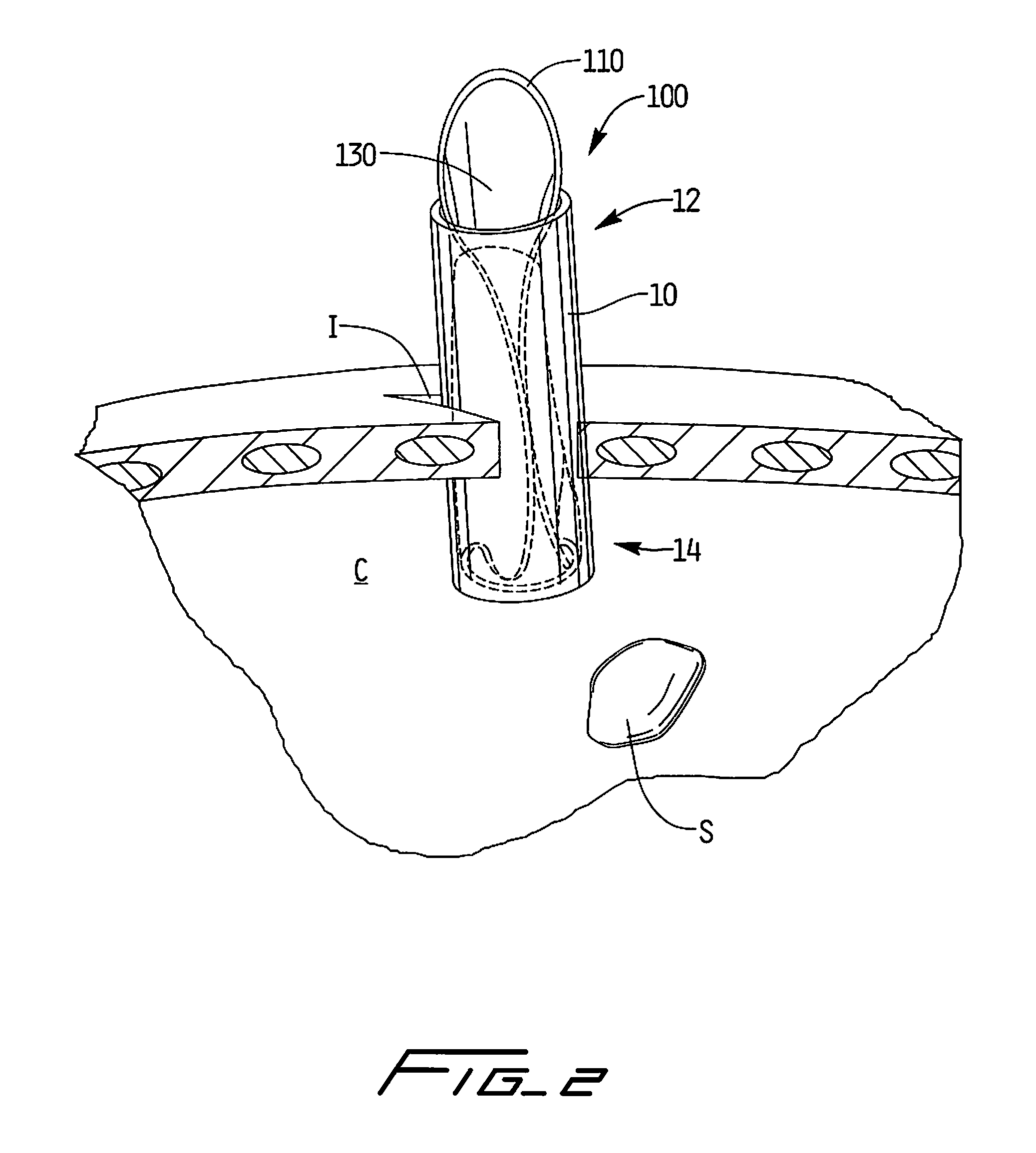 Surgical retrieval apparatus