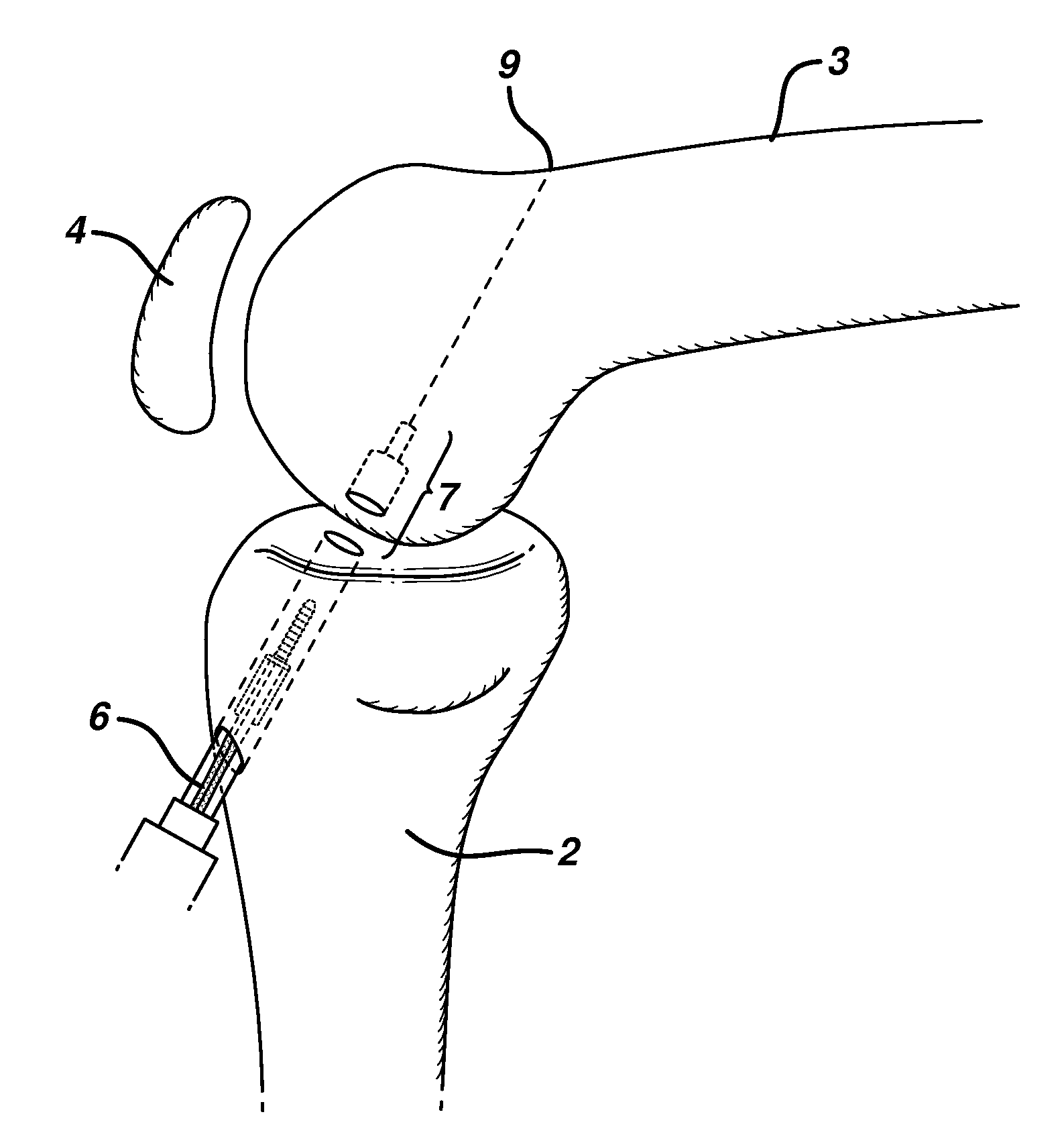 Method for anchoring autologous or artificial tendon grafts in bone