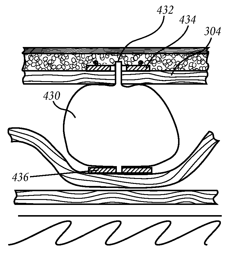 Methods and devices for to treatment of obesity