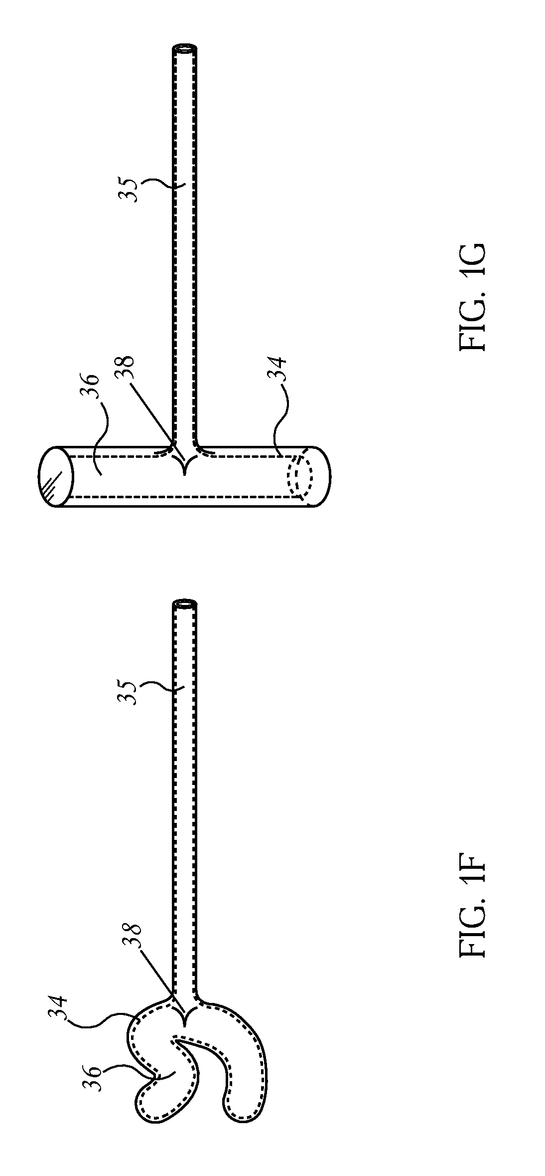 Methods and devices for to treatment of obesity