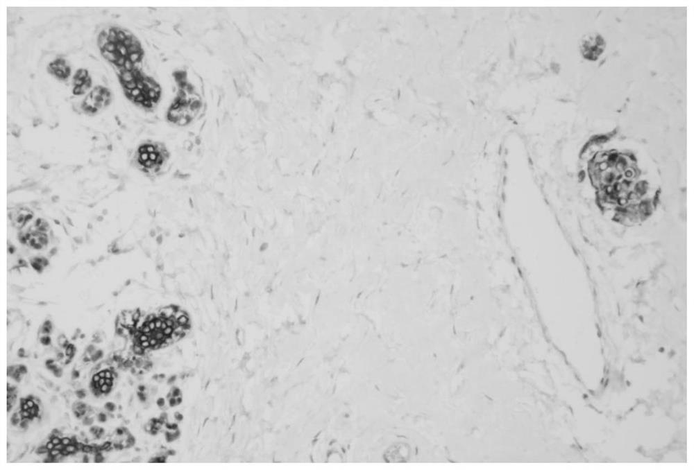 Cocktail immunohistochemical kit for diagnosing breast cancer