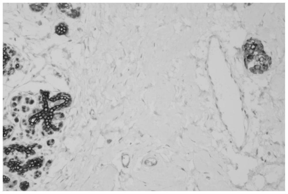 Cocktail immunohistochemical kit for diagnosing breast cancer