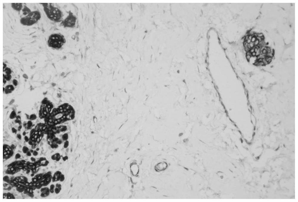 Cocktail immunohistochemical kit for diagnosing breast cancer