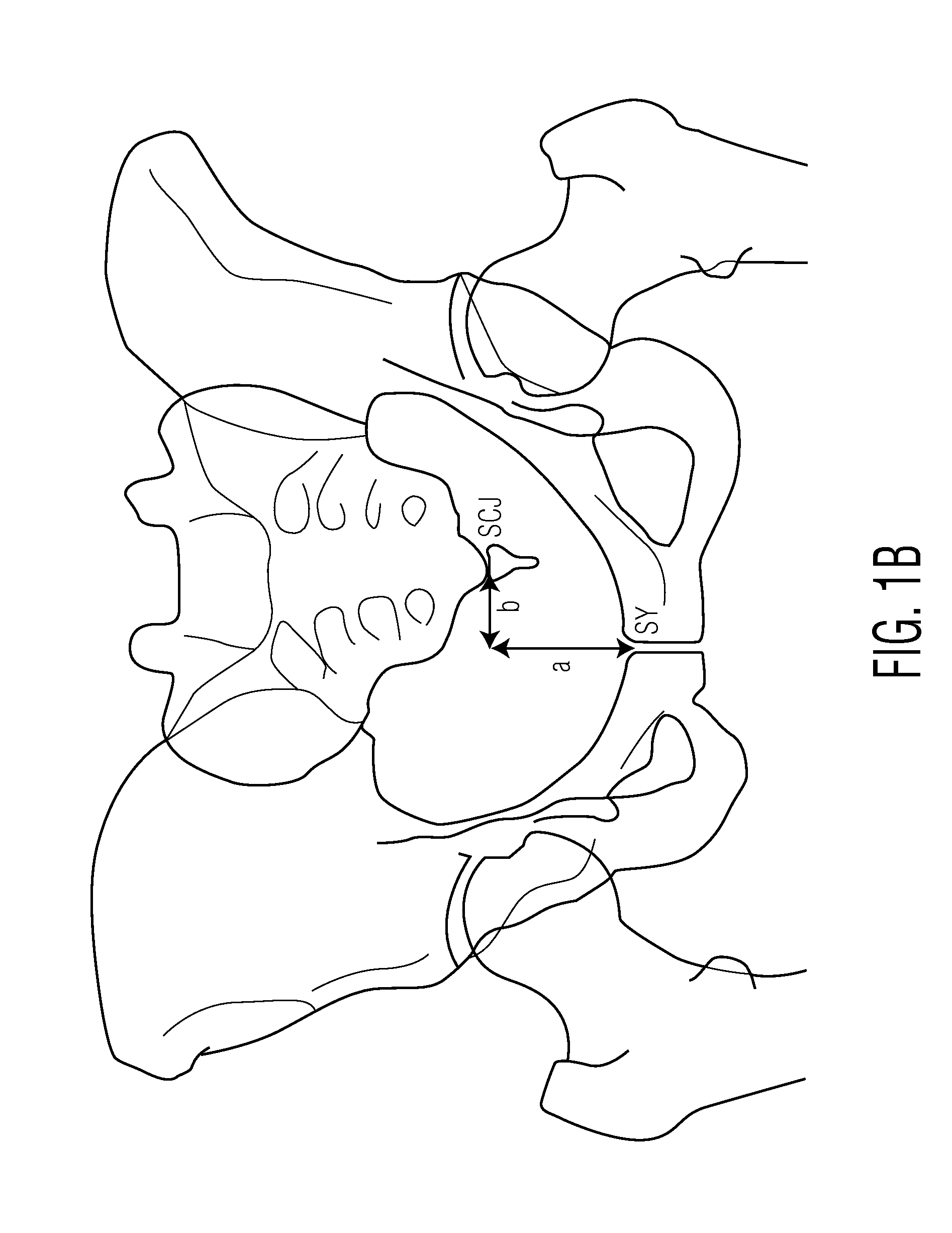 Method for aligning an acetabular cup