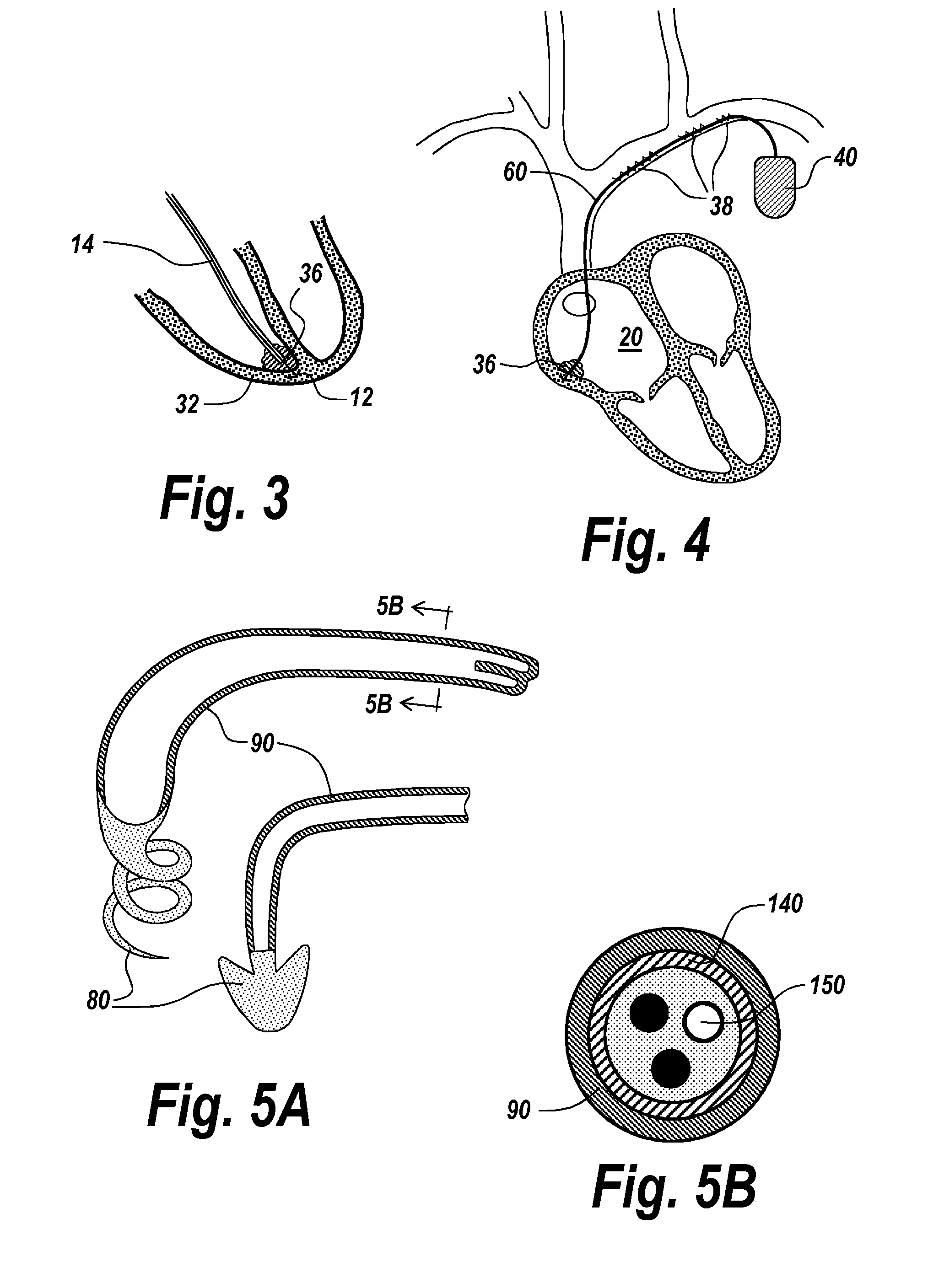 Implantable Medical Devices, Methods of Use, and Apparatus for Extraction Thereof