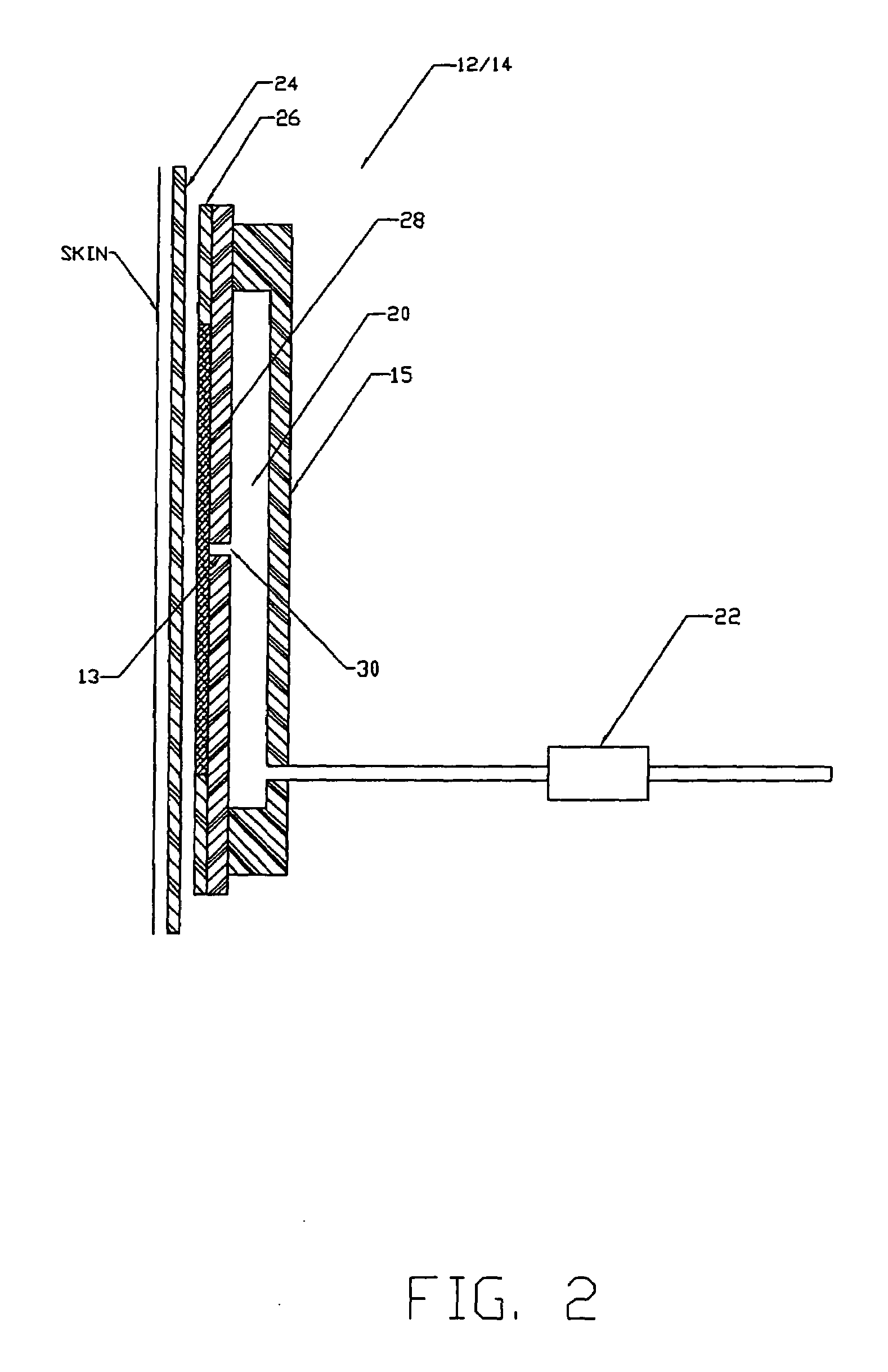 Orthopedic brace having a vacuum chamber and associated methods