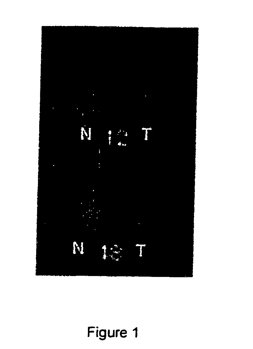 Method for the diagnosis of lymphoproliferative diseases