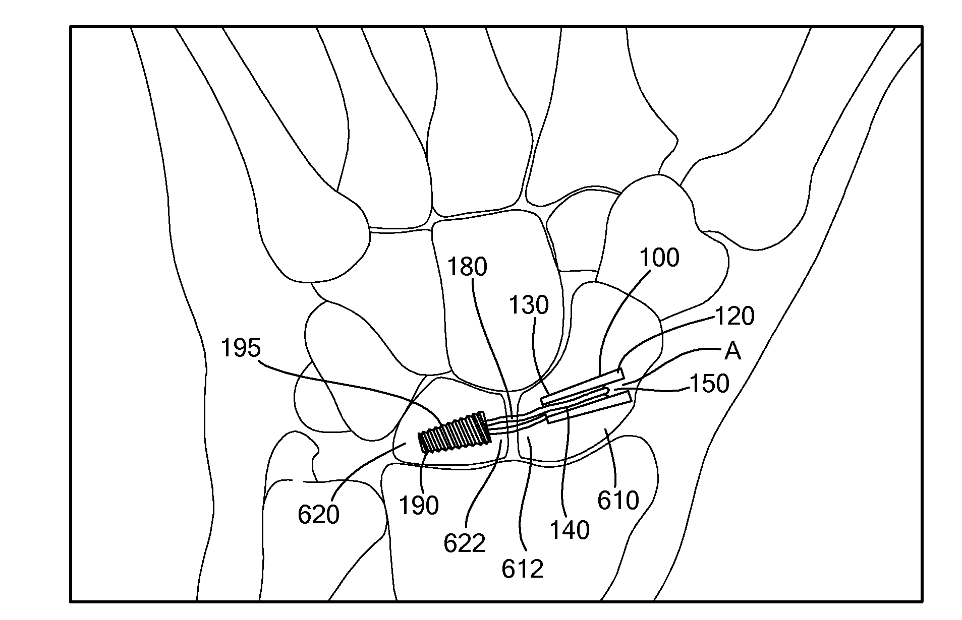 Method and Device for Stabilizing Joints With Limited Axial Movement