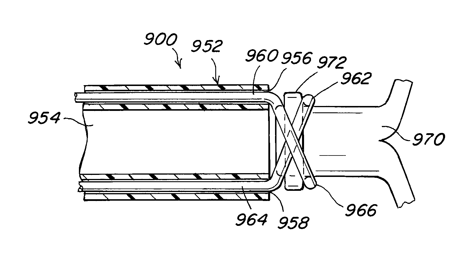 Implant-catheter attachment mechanism using snare and method of use