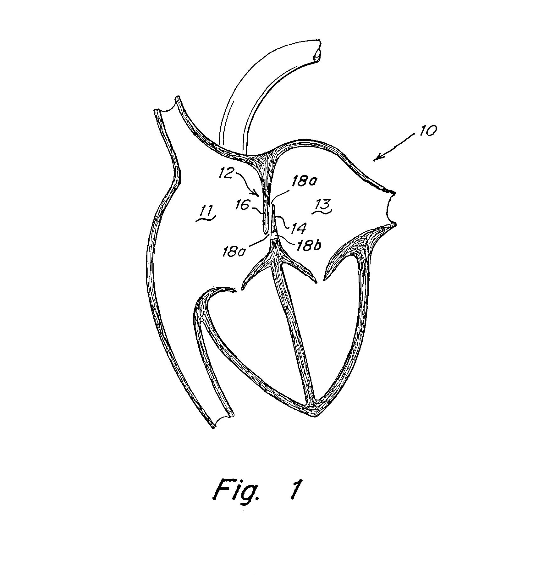 Implant-catheter attachment mechanism using snare and method of use