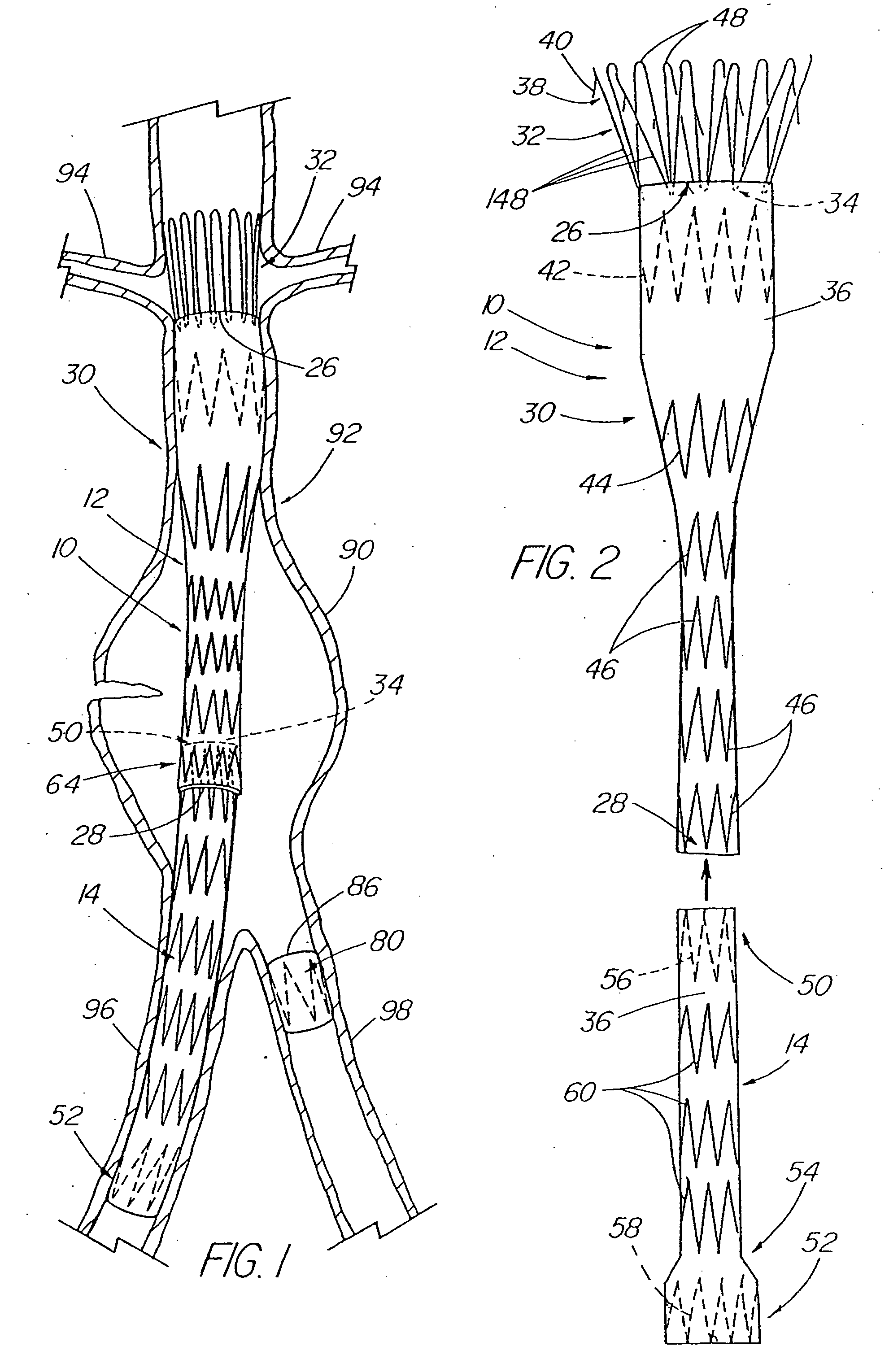 Modular stent graft assembly and use thereof