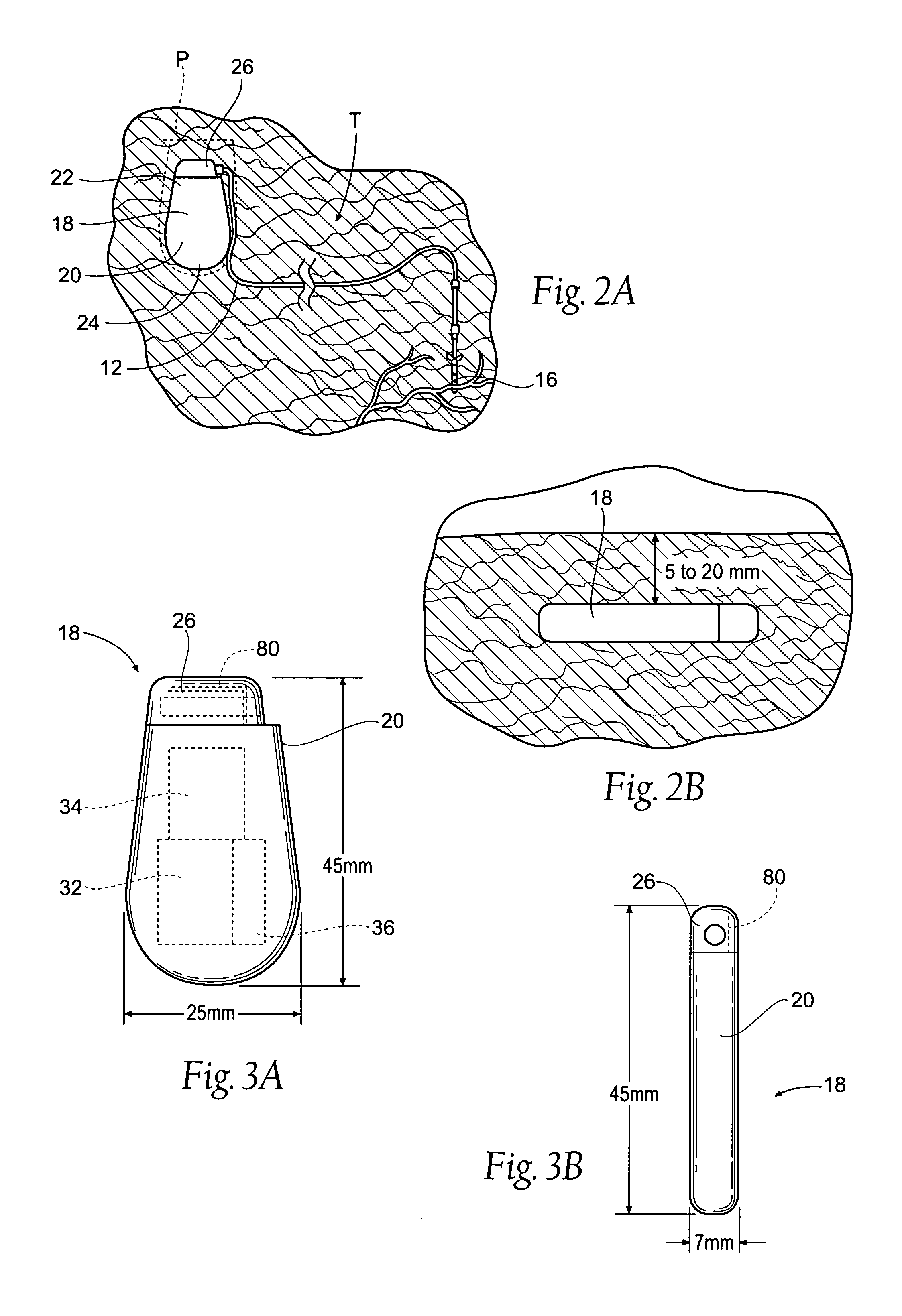 Implantable pulse generator systems and methods for providing functional and / or therapeutic stimulation of muscles and / or nerves and / or central nervous system tissue