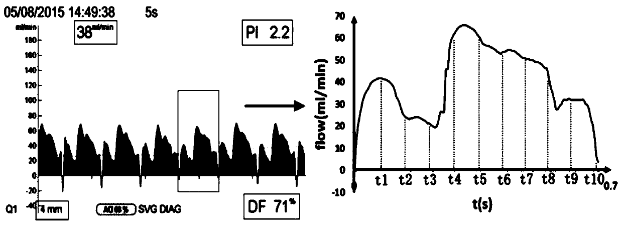 Method for establishing bypass vessel permeability prediction model based on wall surface cutting stress image features during heart bypass surgery