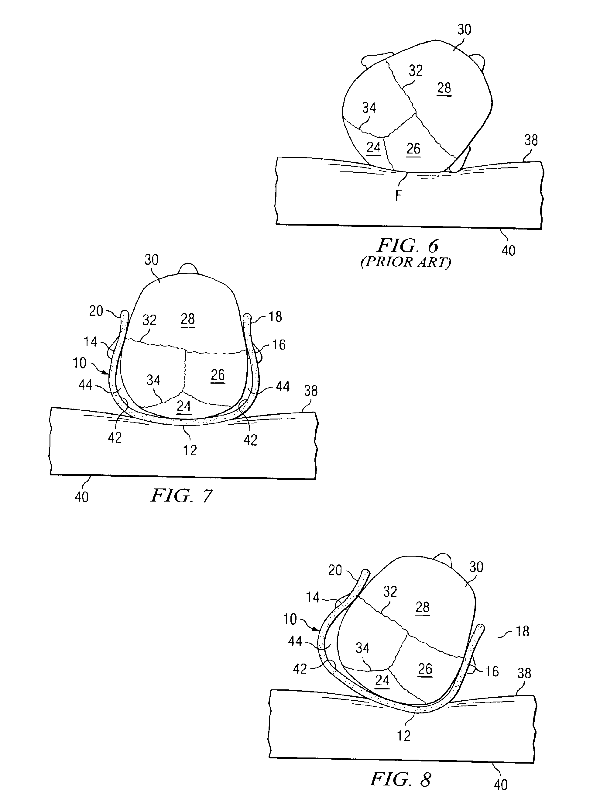 Cranial orthosis for preventing positional plagiocephaly in infants