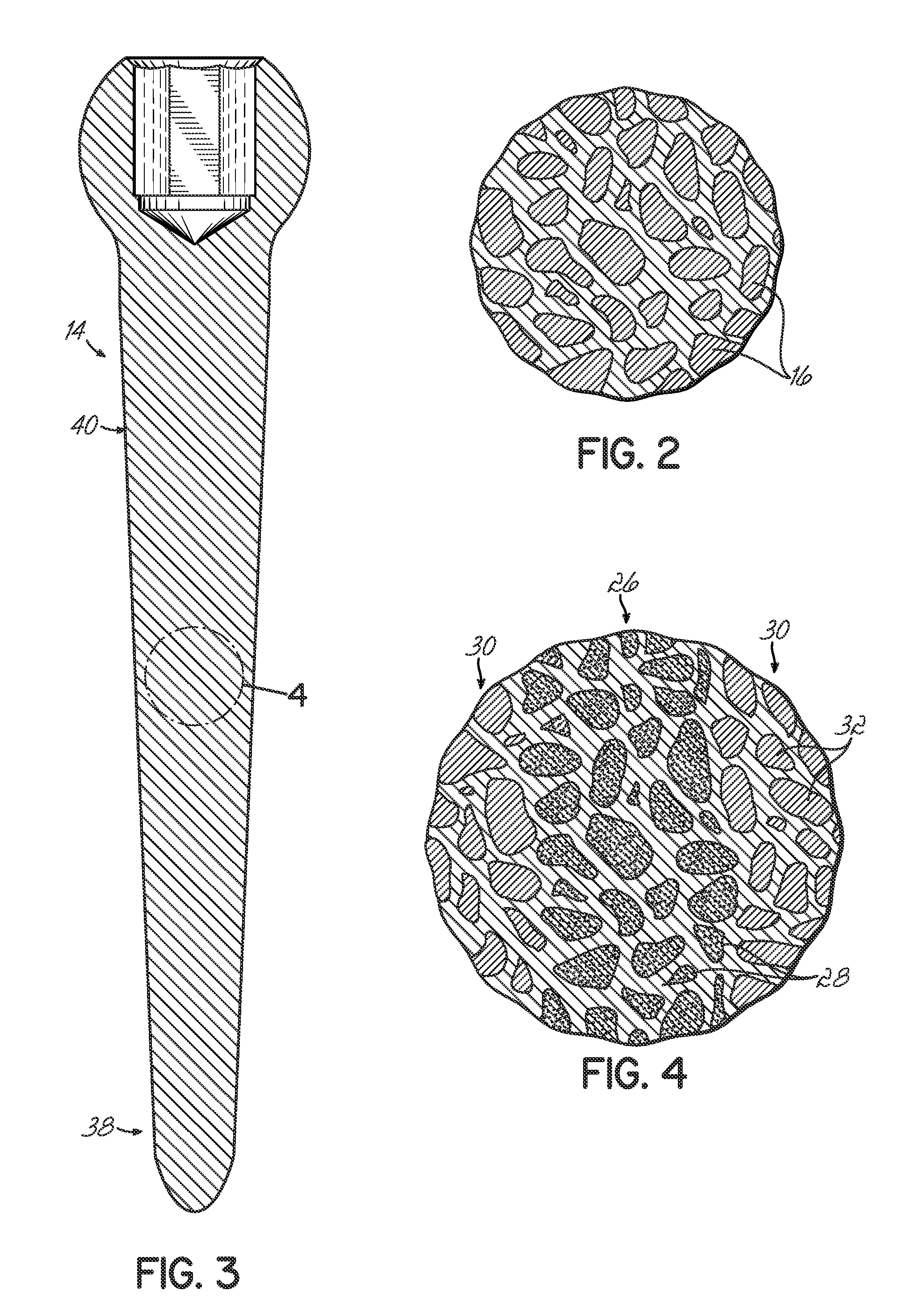 Medical implant formed from porous metal and method