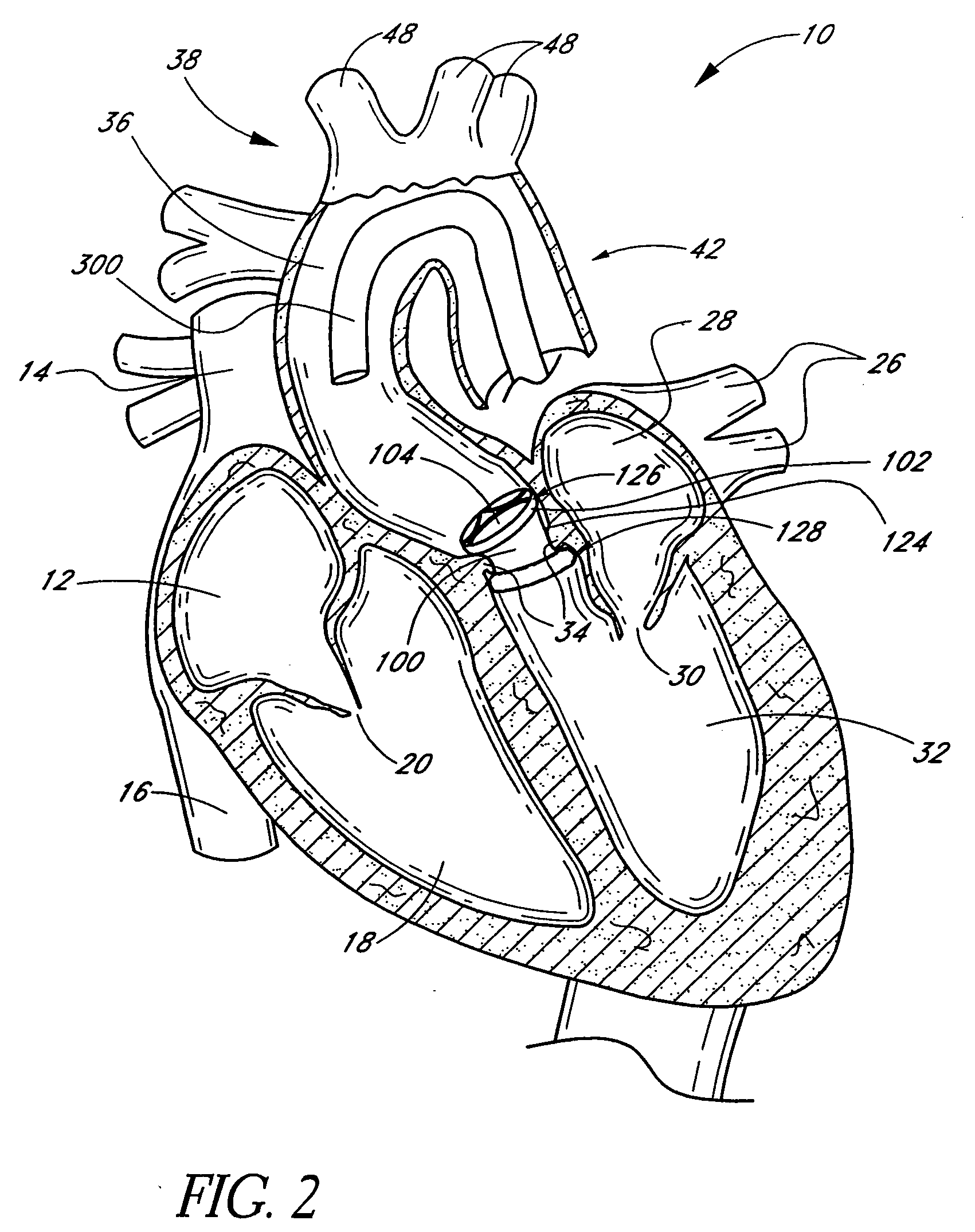 Nonstented heart valves with formed in situ support