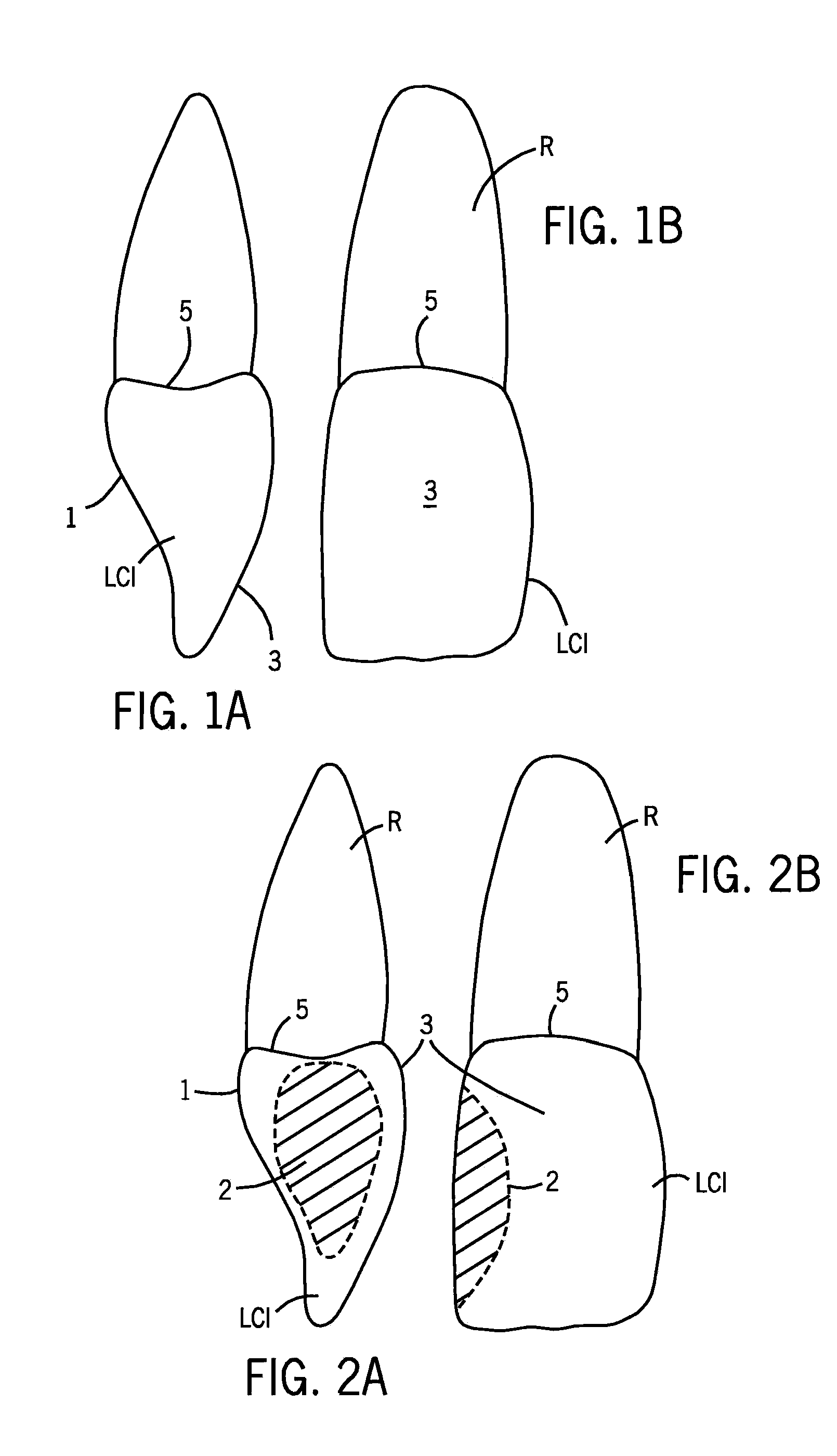 Dental Composite Dispenser For Injection Molded Filling Techniques