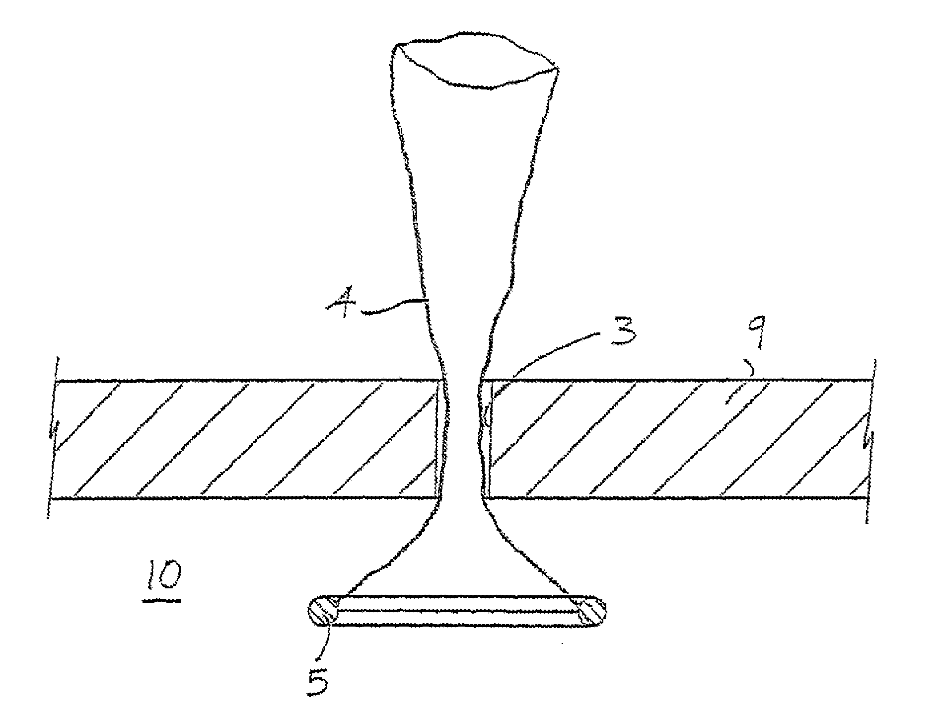 Wound retractor system