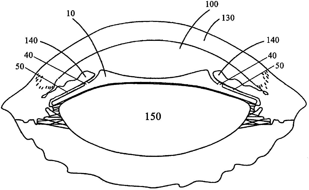 Intraocular lens