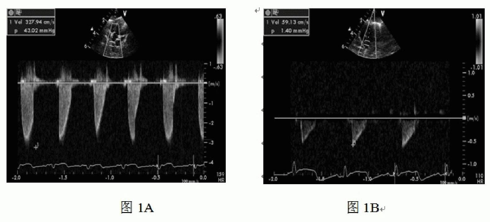 Method for preparing animal model with cardiac hypertrophy by unartificial ventilation