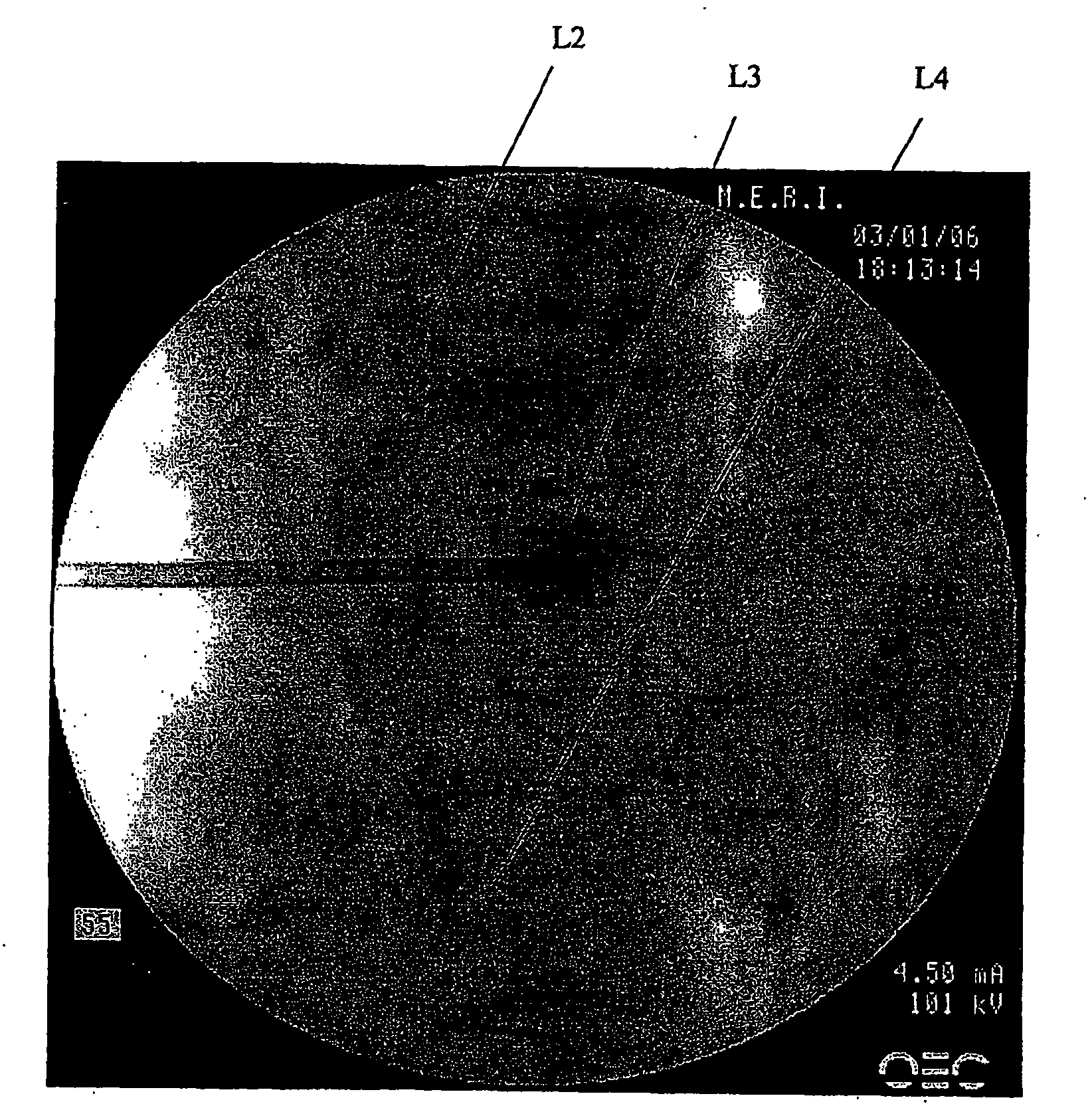 Compositions and methods for treating the vertebral column