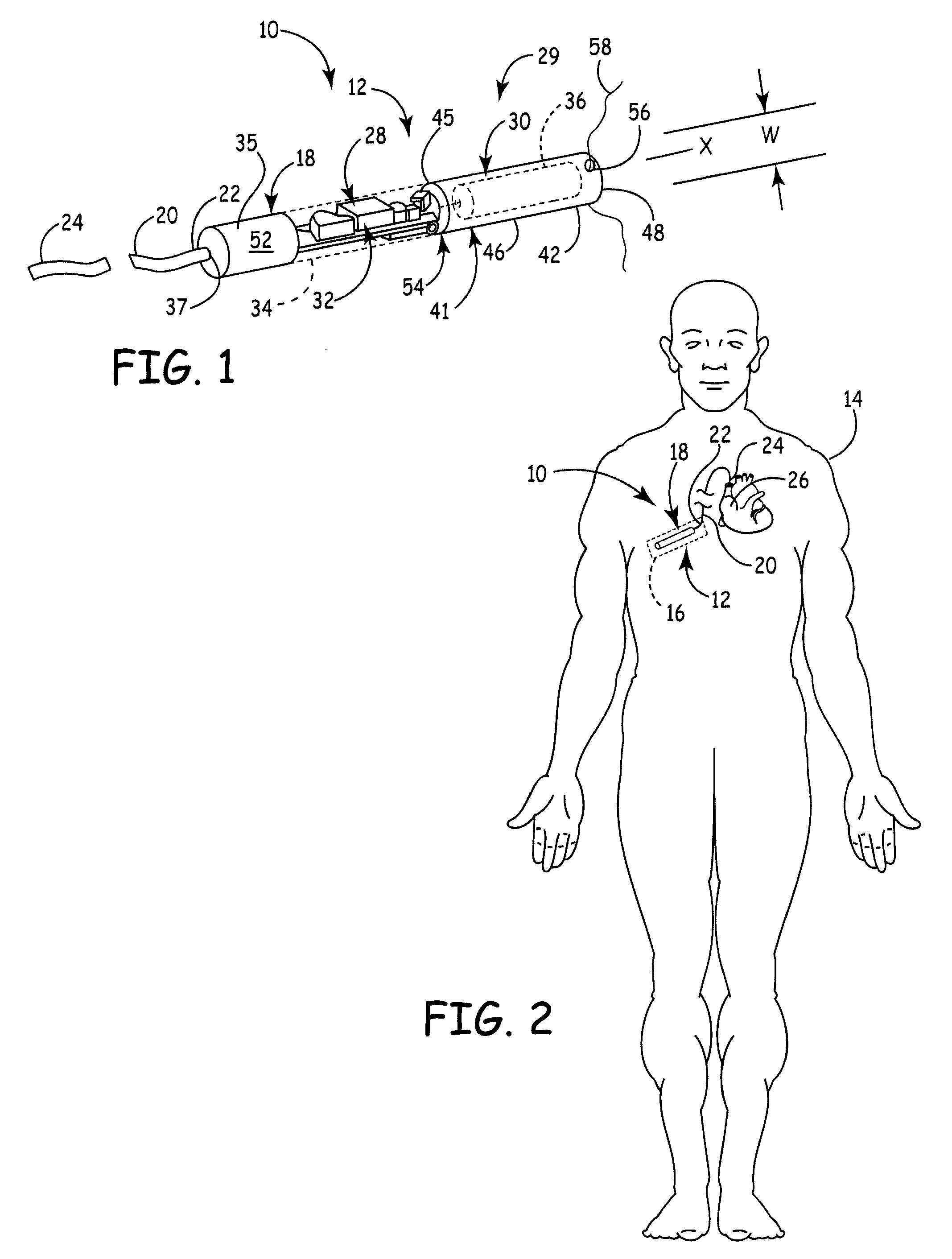 Elongate battery for implantable medical device