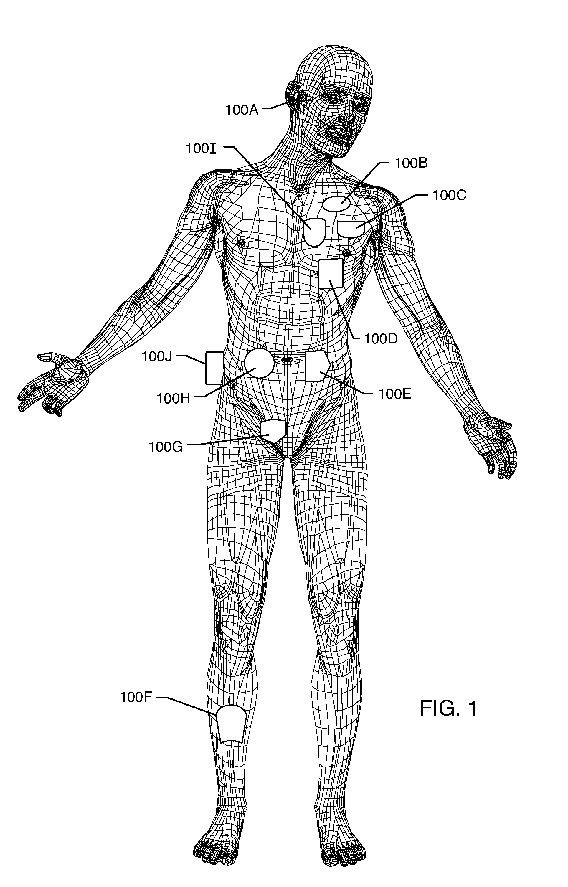 RF filter for an active medical device (AMD) for handling high RF power induced in an associated implanted lead from an external RF field