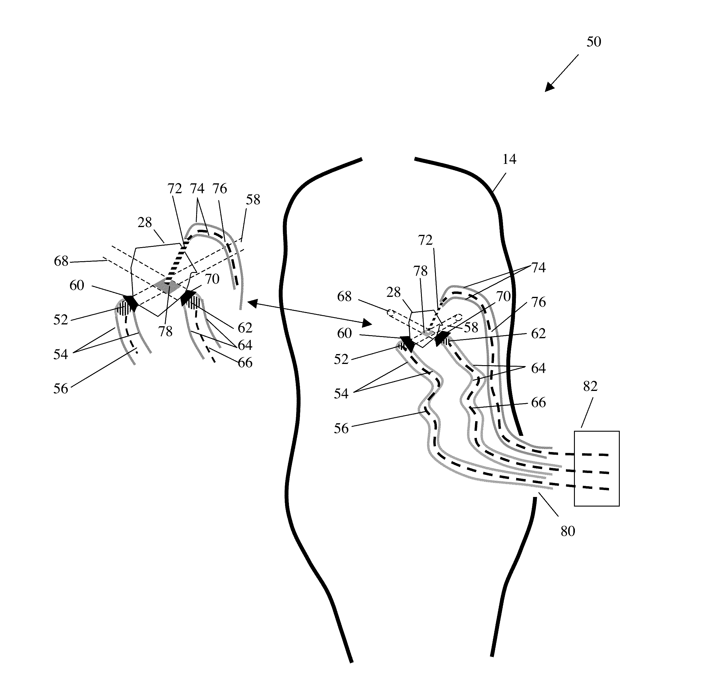 Multi-beam Ultrasound Device