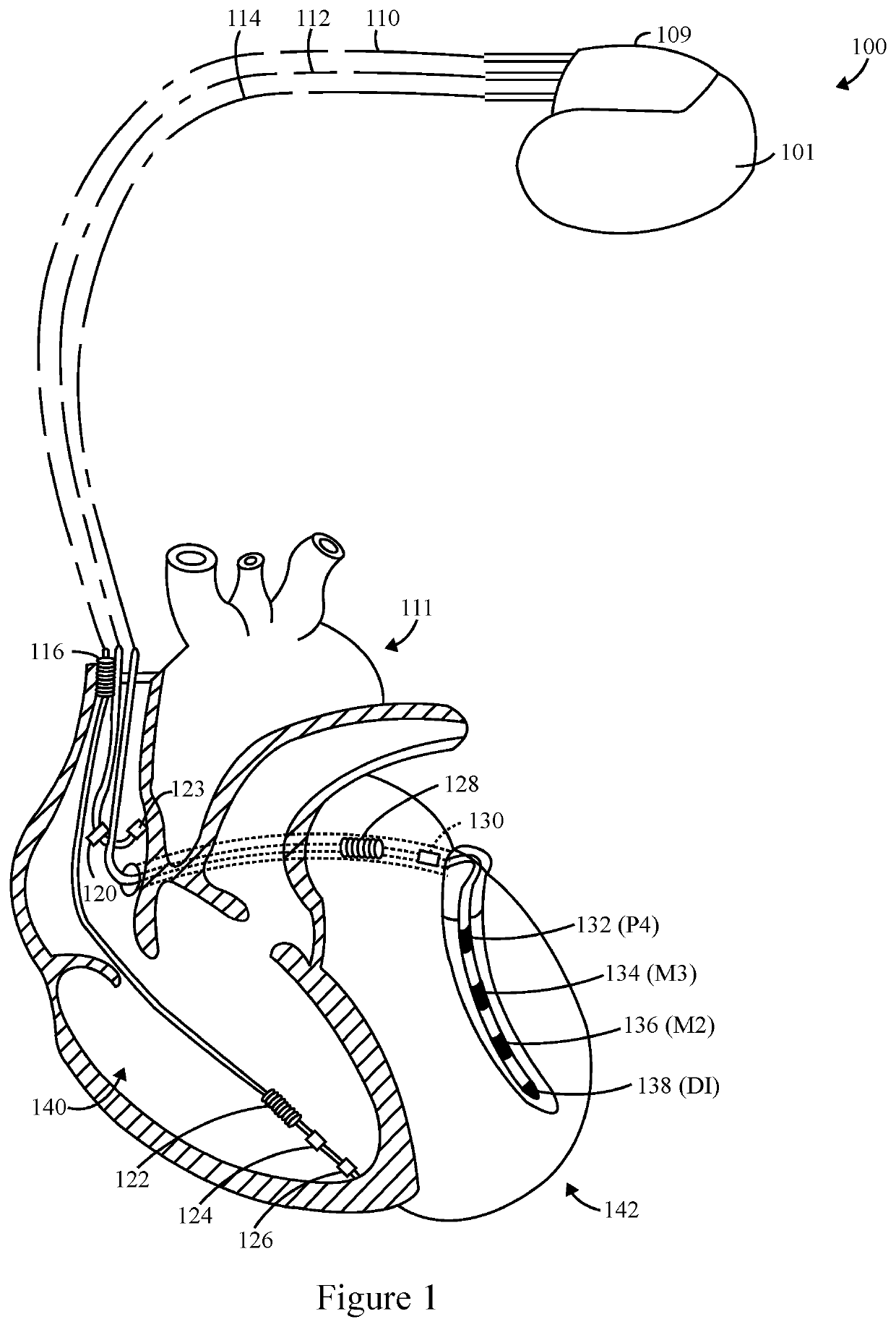 Method and system utilizing a percentage-based atrio-ventricular delay adjustment