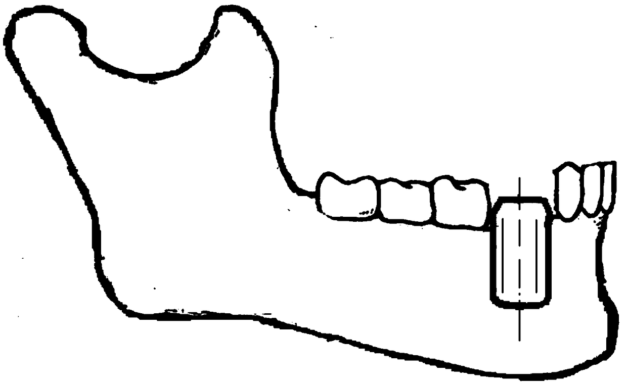 Human-computer cooperative robot tooth-implant method and human-computer cooperative robot tooth-implant system based on augmented reality