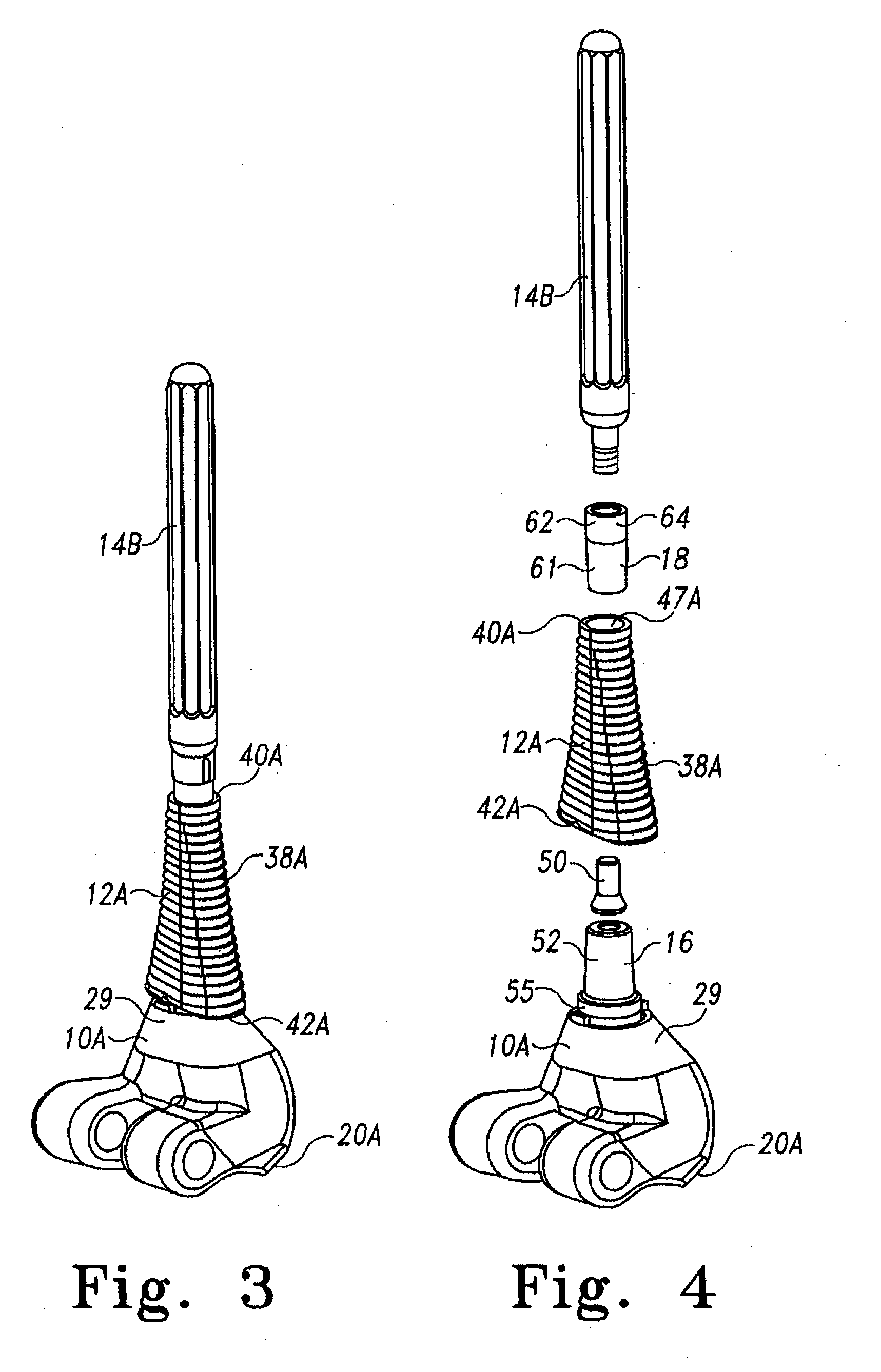 Modular implant system with fully porous coated sleeve