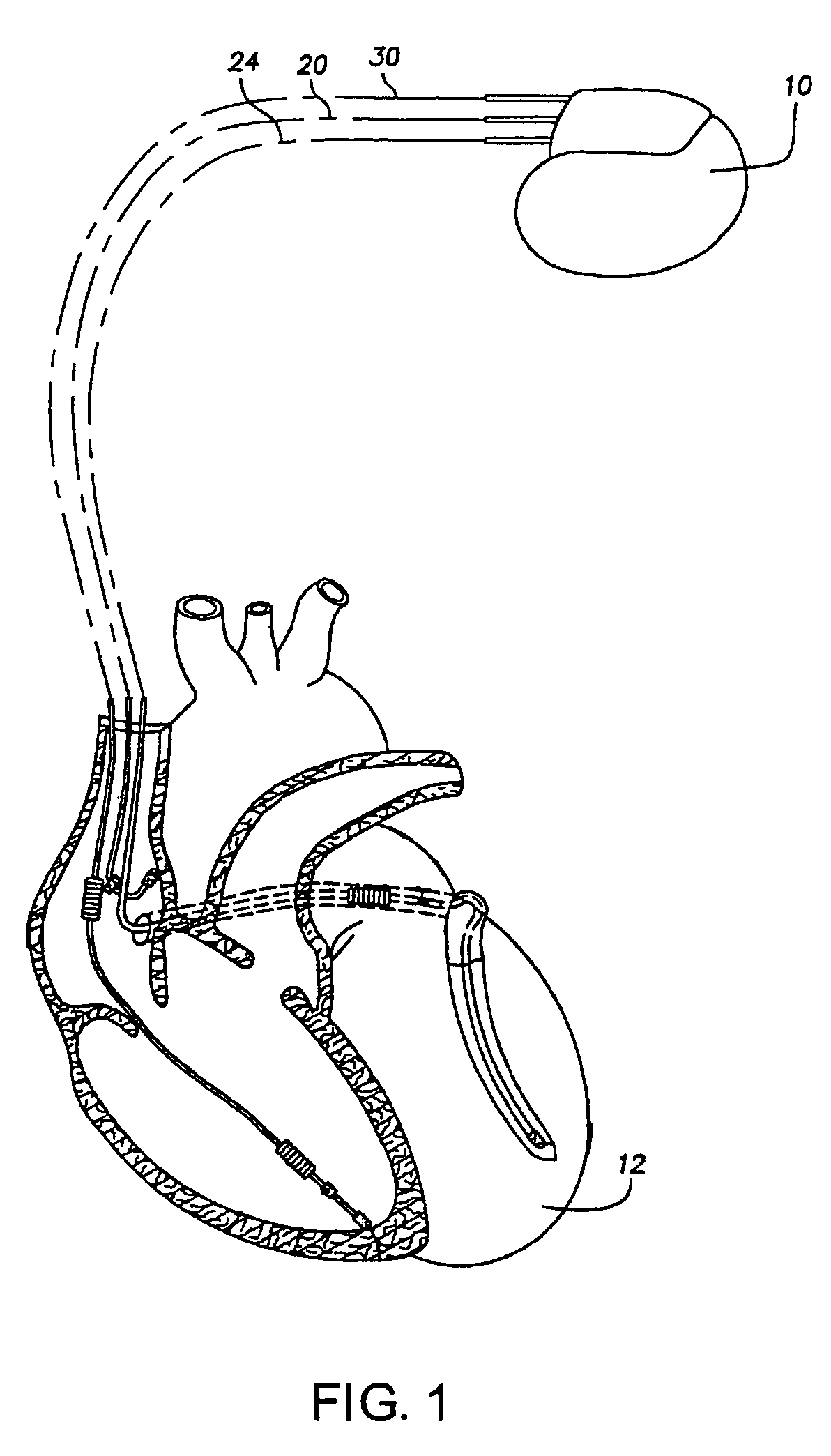 Method and apparatus for measuring battery depletion in implantable medical devices